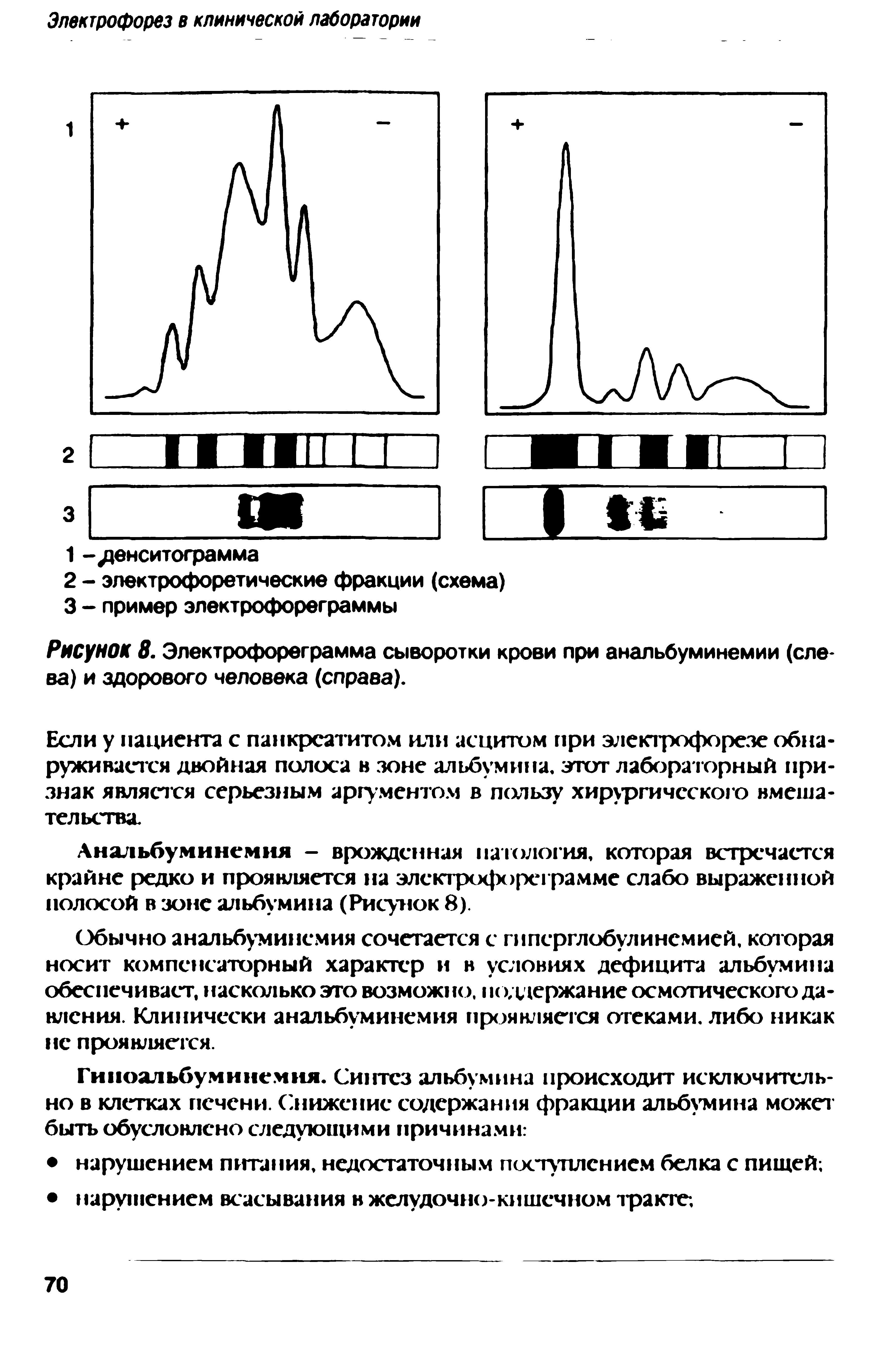 Рисунок 8. Электрофореграмма сыворотки крови при анальбуминемии (слева) и здорового человека (справа).