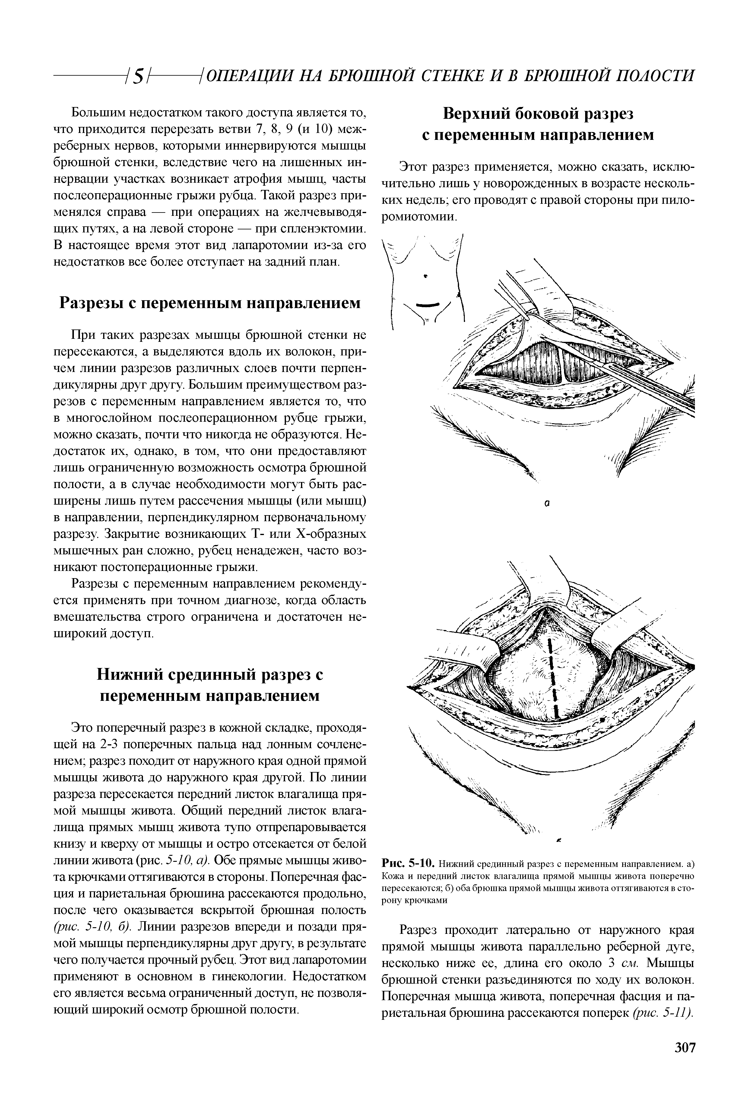 Рис. 5-10. Нижний срединный разрез с переменным направлением, а) Кожа и передний листок влагалища прямой мышцы живота поперечно пересекаются б) оба брюшка прямой мышцы живота оттягиваются в сторону крючками...