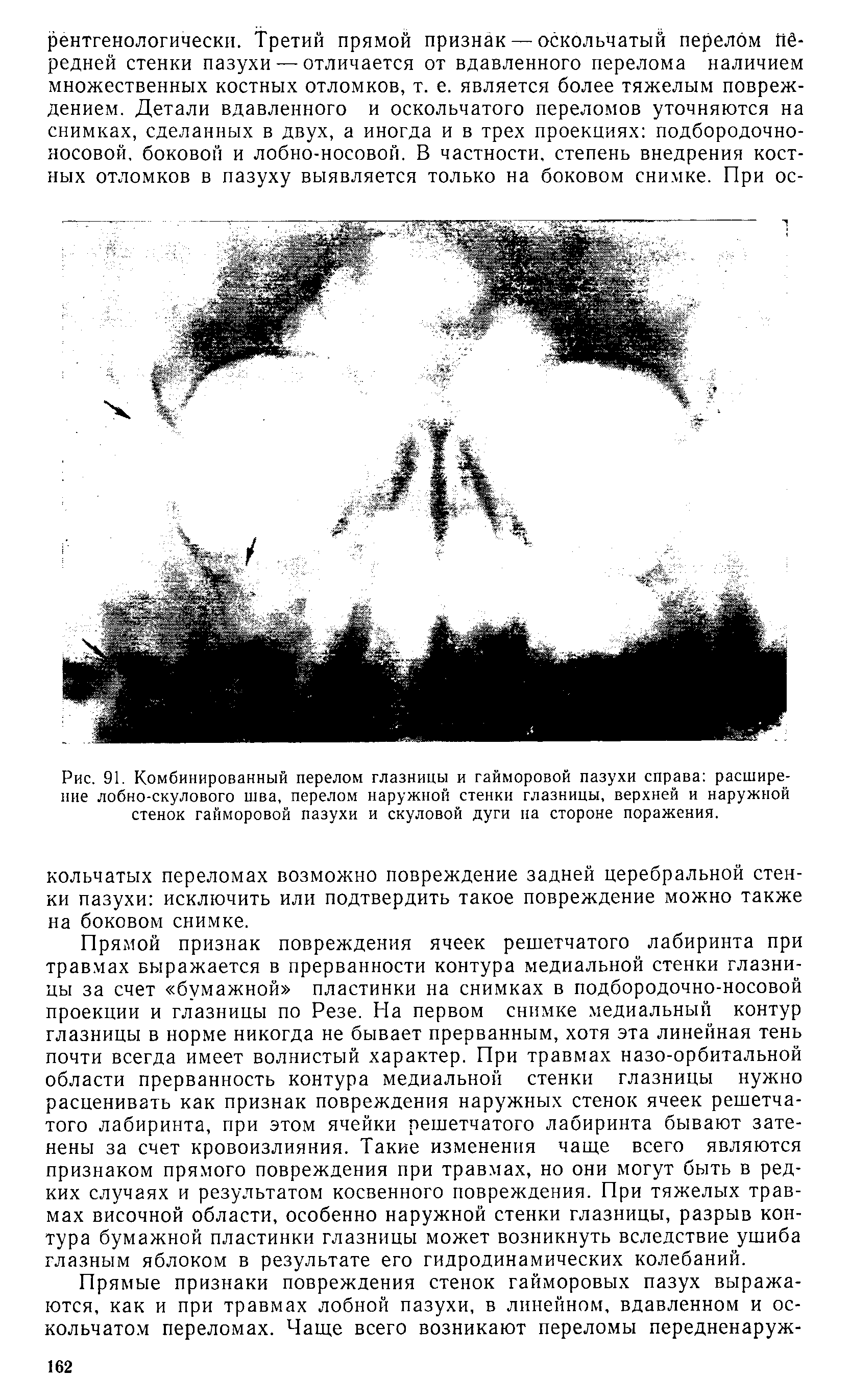 Рис. 91. Комбинированный перелом глазницы и гайморовой пазухи справа расширение лобно-скулового шва, перелом наружной стенки глазницы, верхней и наружной стенок гайморовой пазухи и скуловой дуги на стороне поражения.