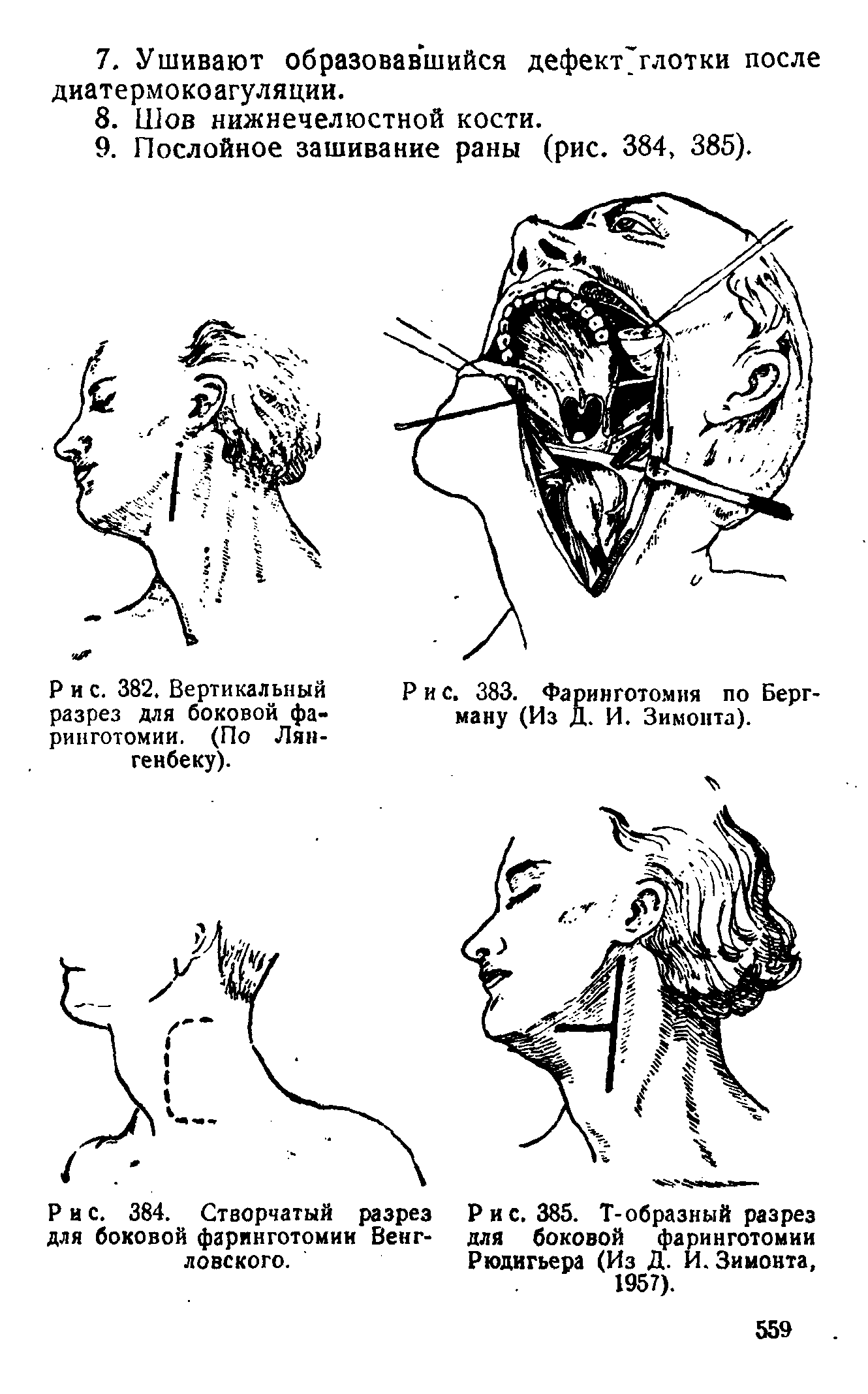 Рис. 384. Створчатый разрез Рис. 385. Т-образный разрез для боковой фаринготомии Венг- для боковой фаринготомии ловского. Рюдигьера (Из Д. И. Зимонта,...