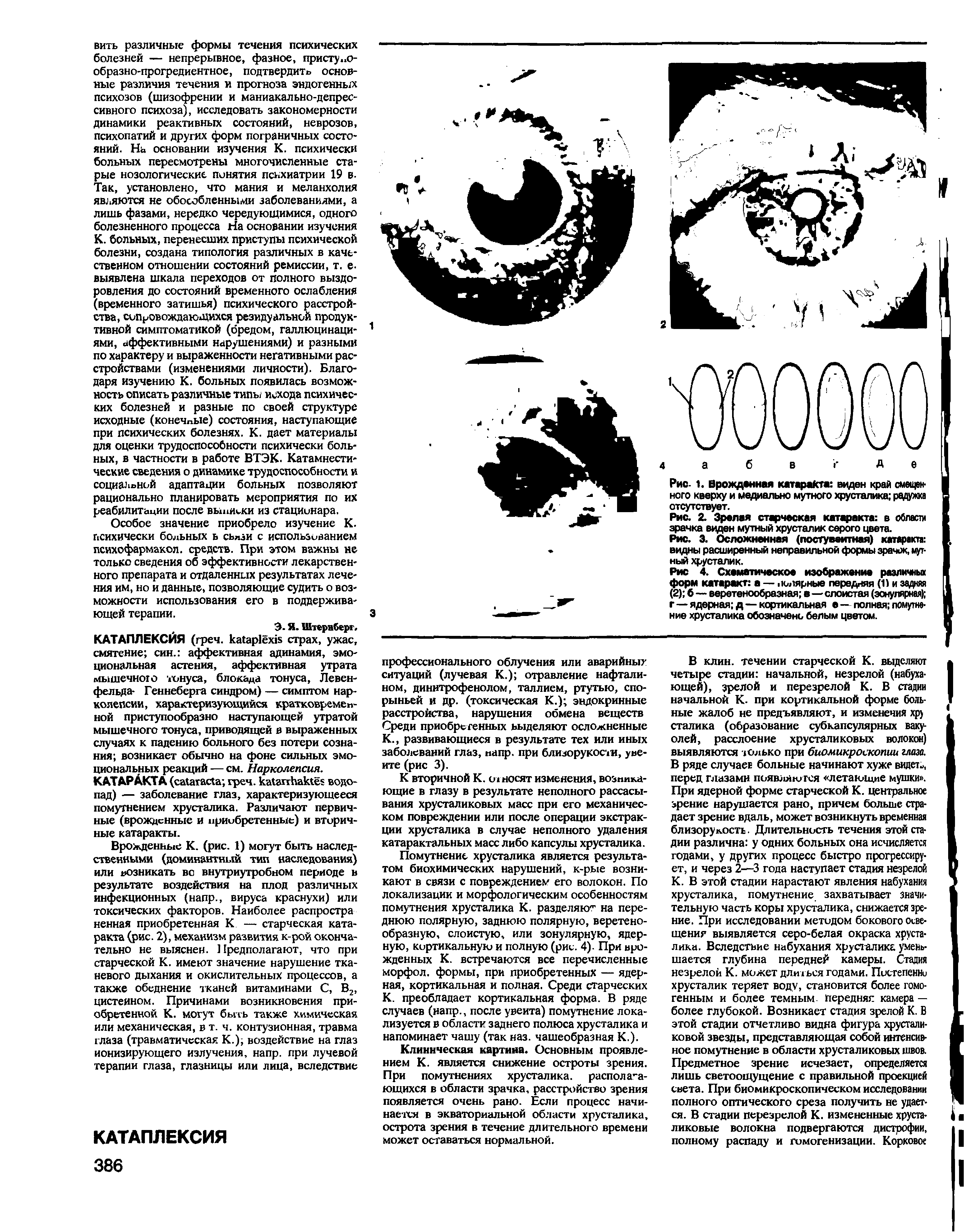 Рис. 3. Осложненная (посгувеитная) катаракта видны расширенный неправильной формы зрачок, мутный хрусталик.