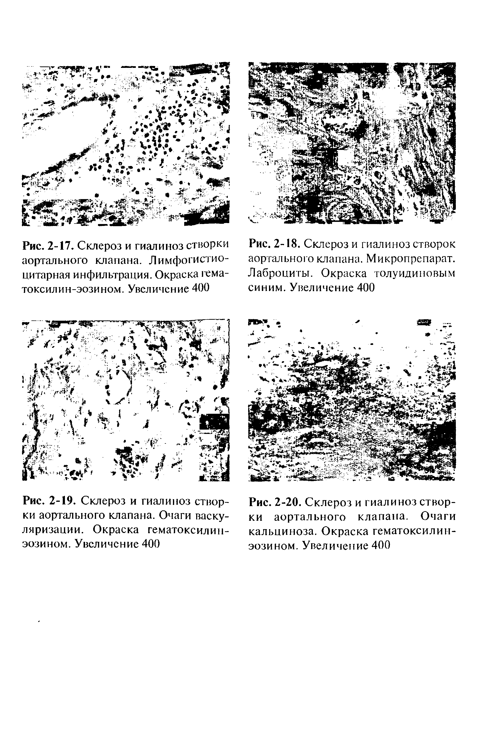 Рис. 2-18. Склероз и гиалиноз створок аортального клапана. Микропрепарат. Лаброциты. Окраска толуидиновым синим. Увеличение 400...