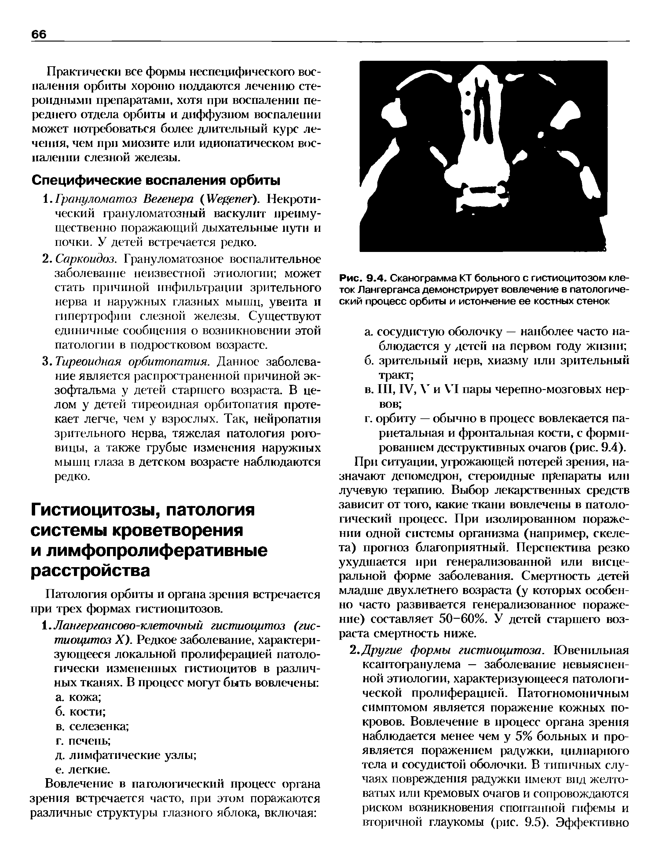 Рис. 9.4. Сканограмма КТ больного с гистиоцитозом клеток Лангерганса демонстрирует вовлечение в патологический процесс орбиты и истончение ее костных стенок...