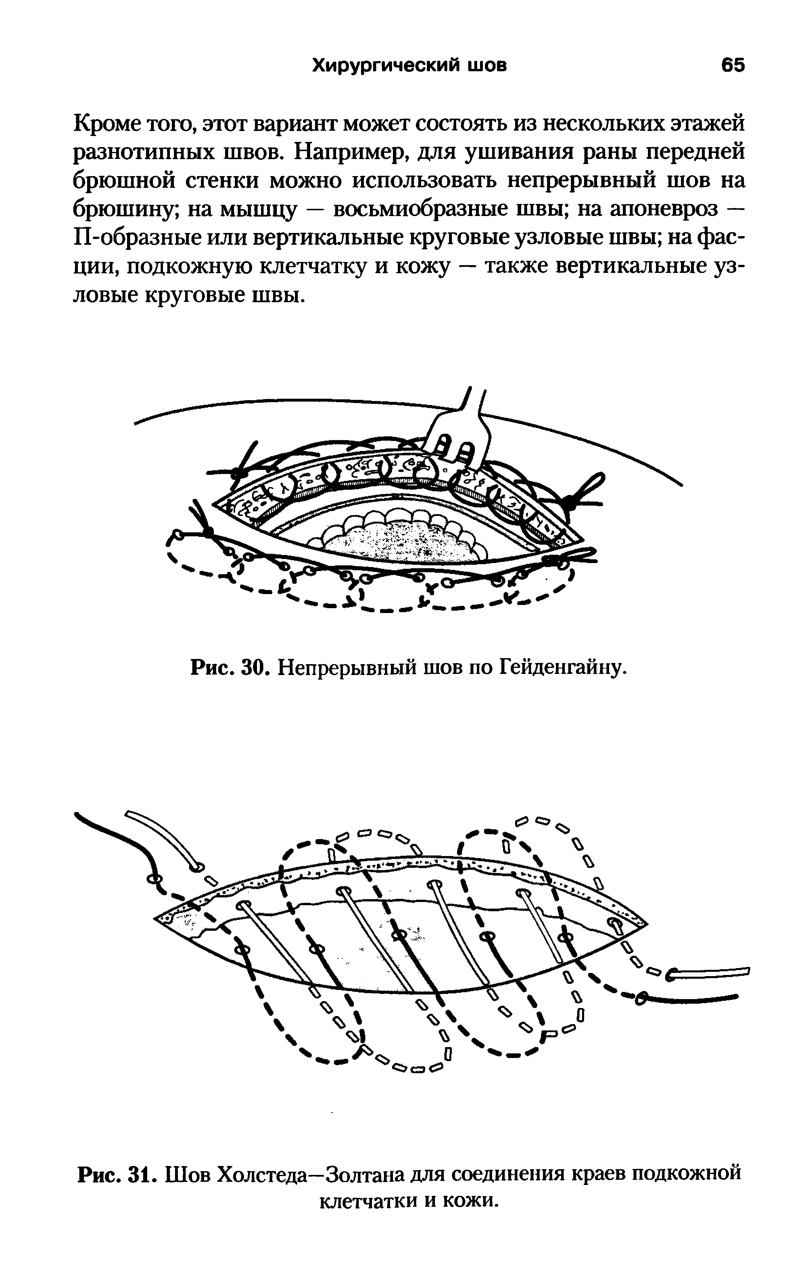 Рис. 31. Шов Холстеда—Золтана для соединения краев подкожной клетчатки и кожи.