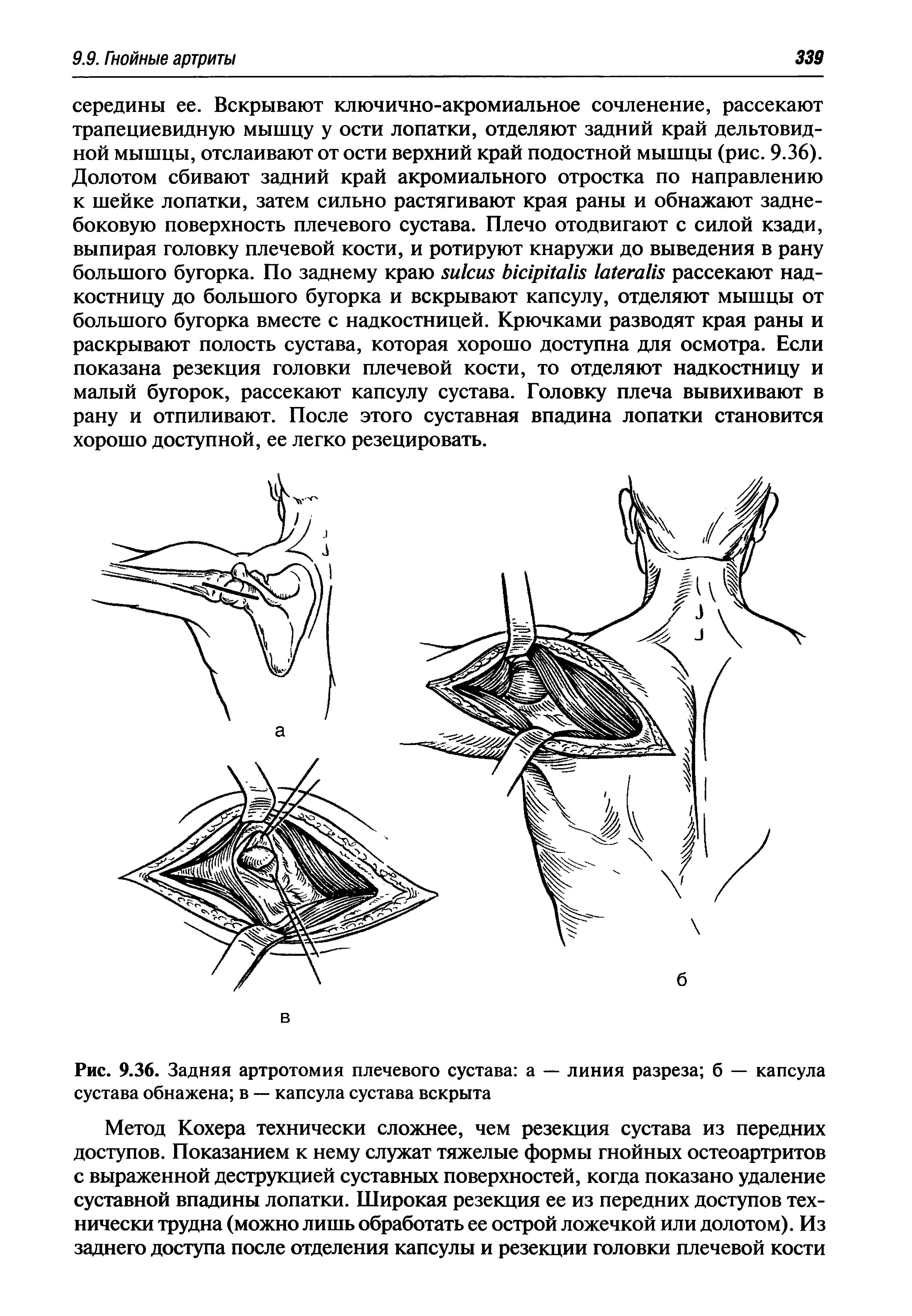 Рис. 9.36. Задняя артротомия плечевого сустава а — линия разреза б — капсула сустава обнажена в — капсула сустава вскрыта...
