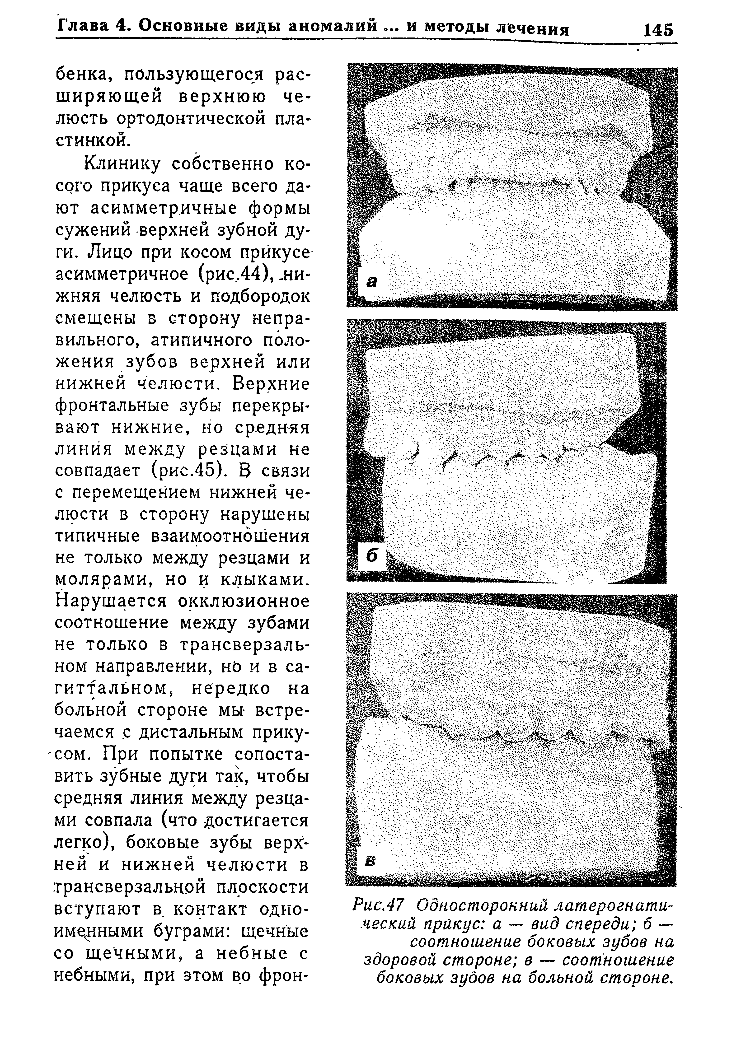 Рис.47 Односторонний латерогнати,-неский прикус а — вид спереди 6 — соотношение боковых зубов на здоровой стороне в — соотношение боковых зубов на больной стороне.