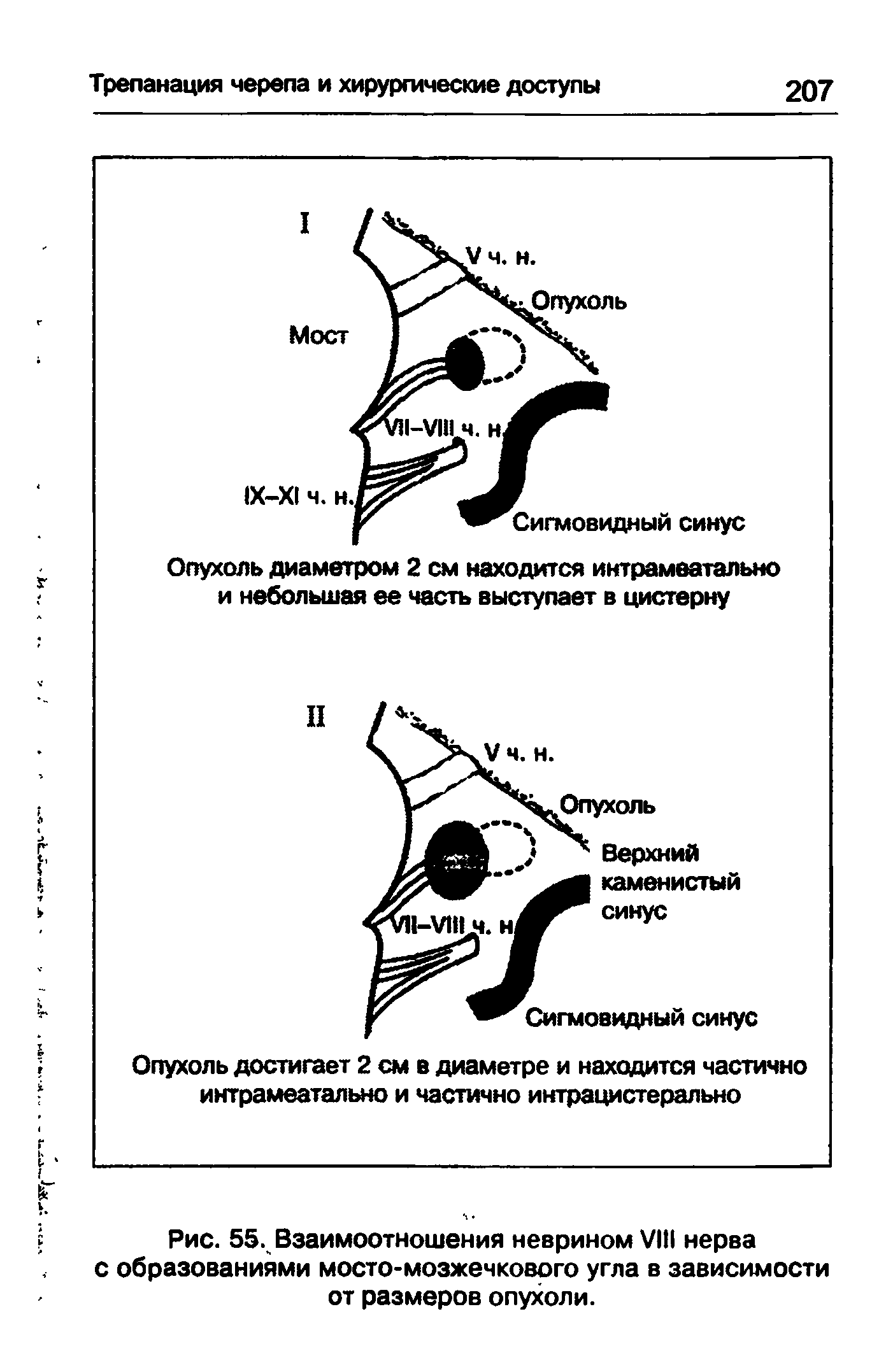 Рис. 55. Взаимоотношения неврином VIII нерва с образованиями мосто-мозжечкового угла в зависимости от размеров опухоли.