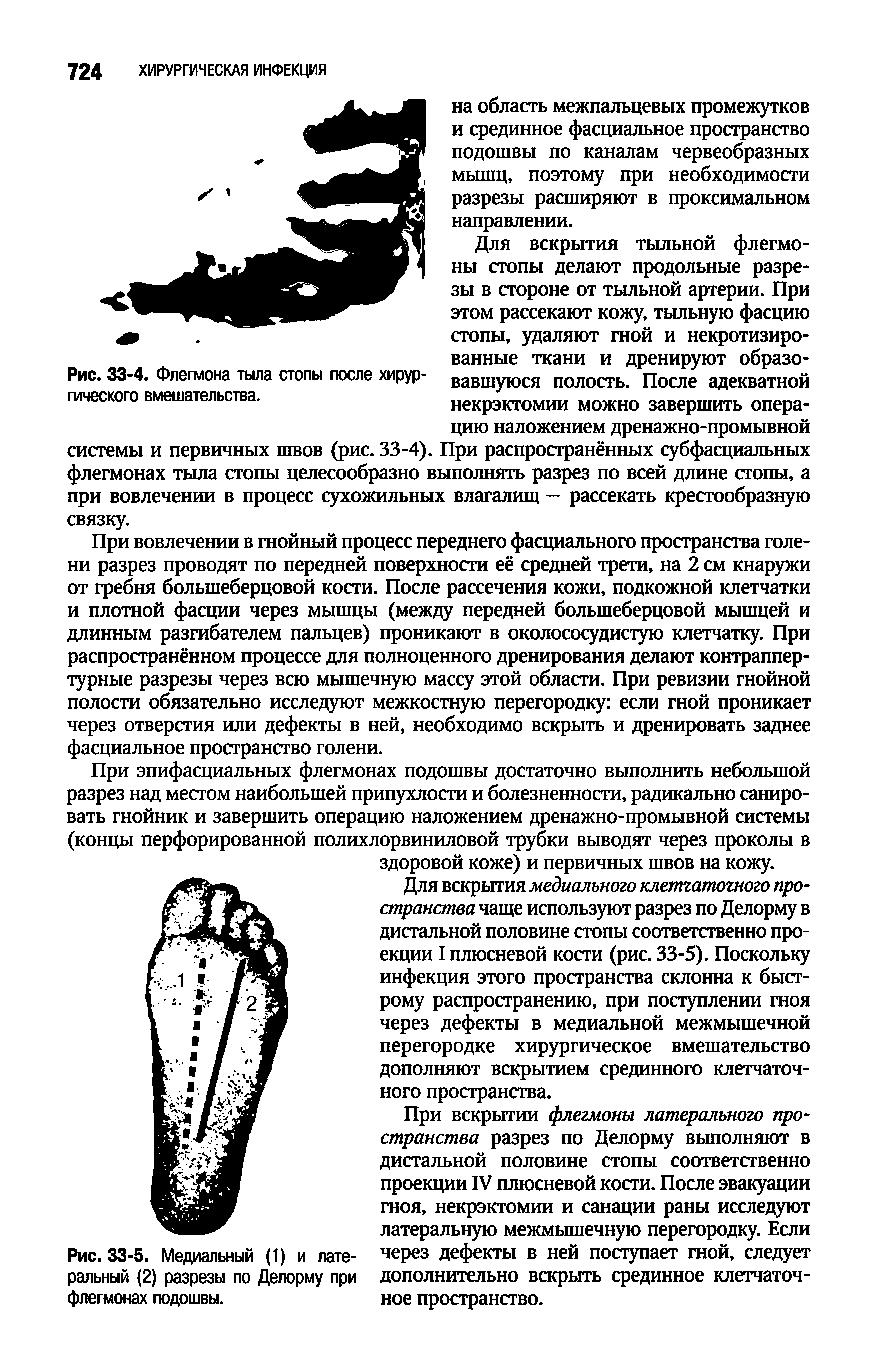 Рис. 33-5. Медиальный (1) и лате- чеРез дефекты в ней поступает гной, следует ральный (2) разрезы по Делорму при дополнительно вскрыть срединное клетчаточ-флегмонах подошвы. ное пространство.