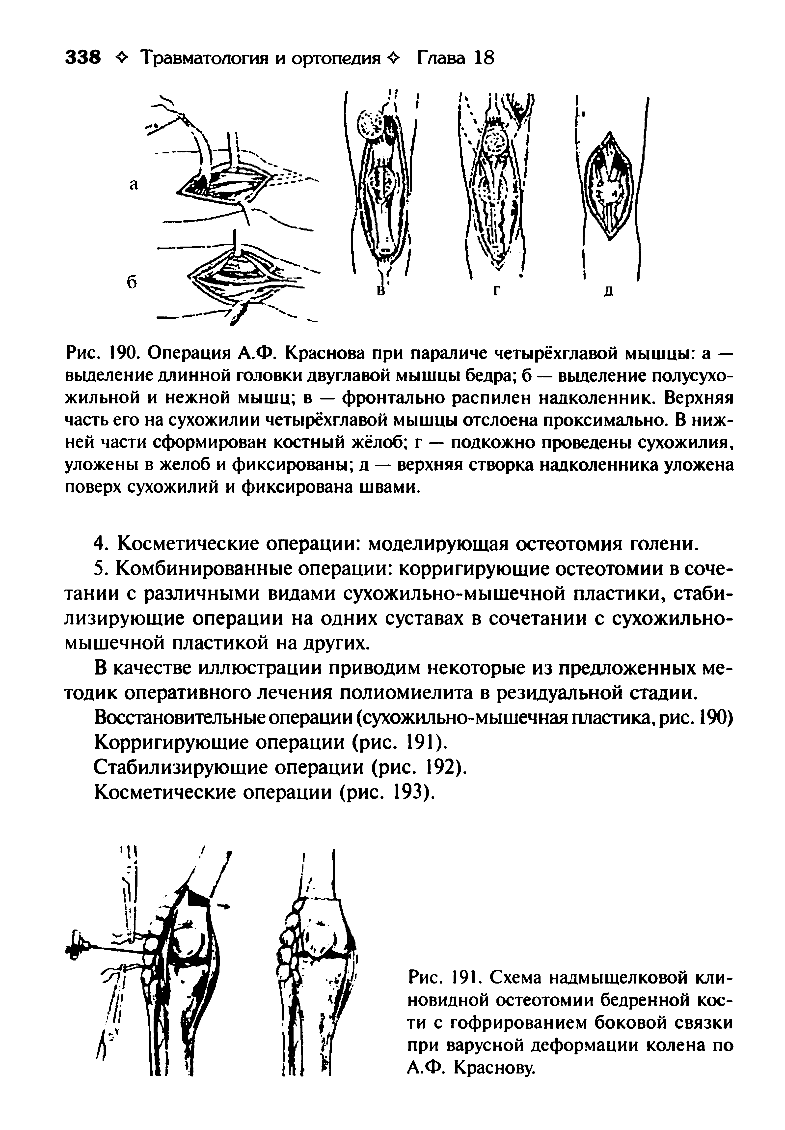 Рис. 191. Схема надмыщелковой клиновидной остеотомии бедренной кости с гофрированием боковой связки при варусной деформации колена по А.Ф. Краснову.