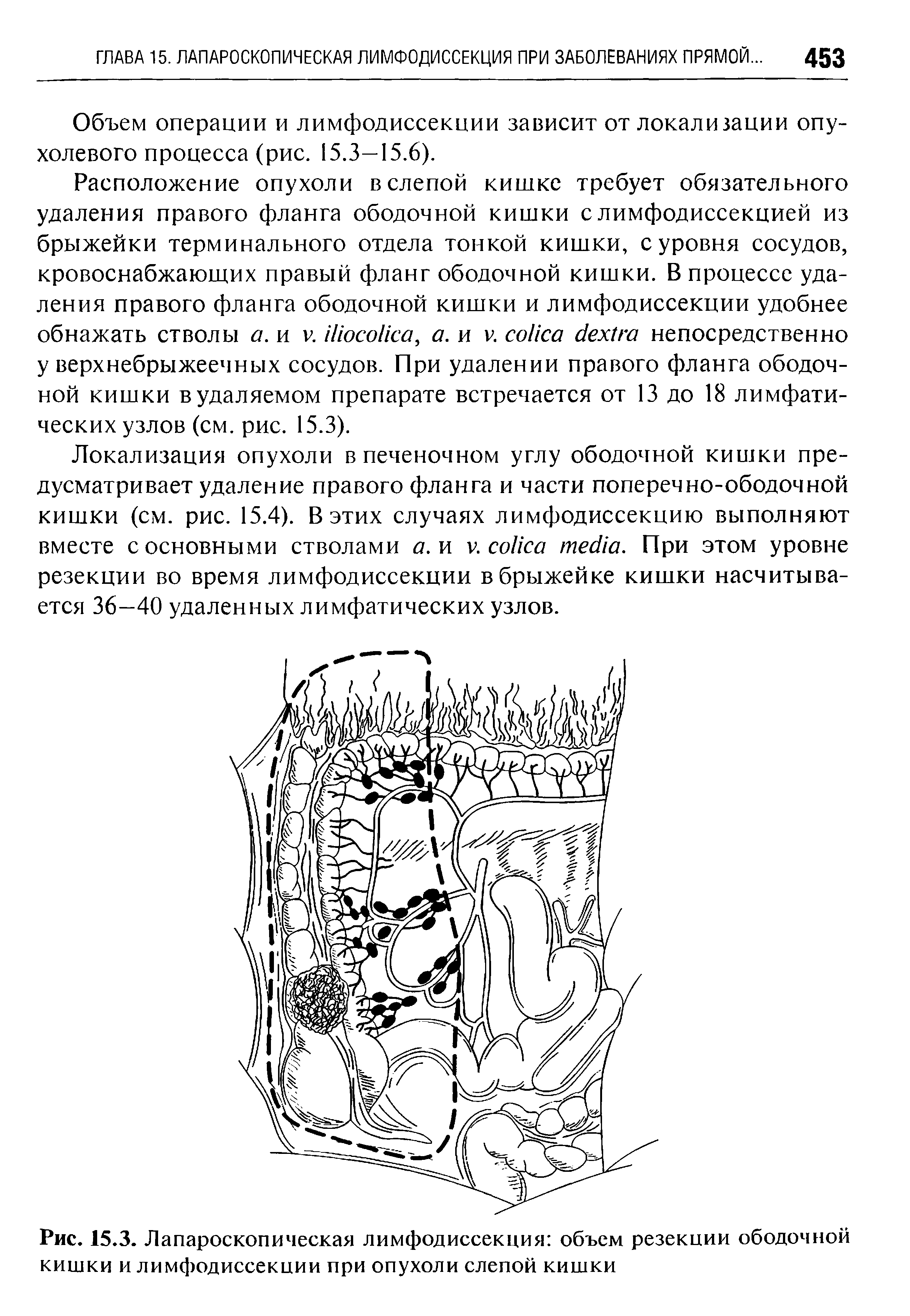 Рис. 15.3. Лапароскопическая лимфодиссекции объем резекции ободочной кишки и лимфодиссекции при опухоли слепой кишки...