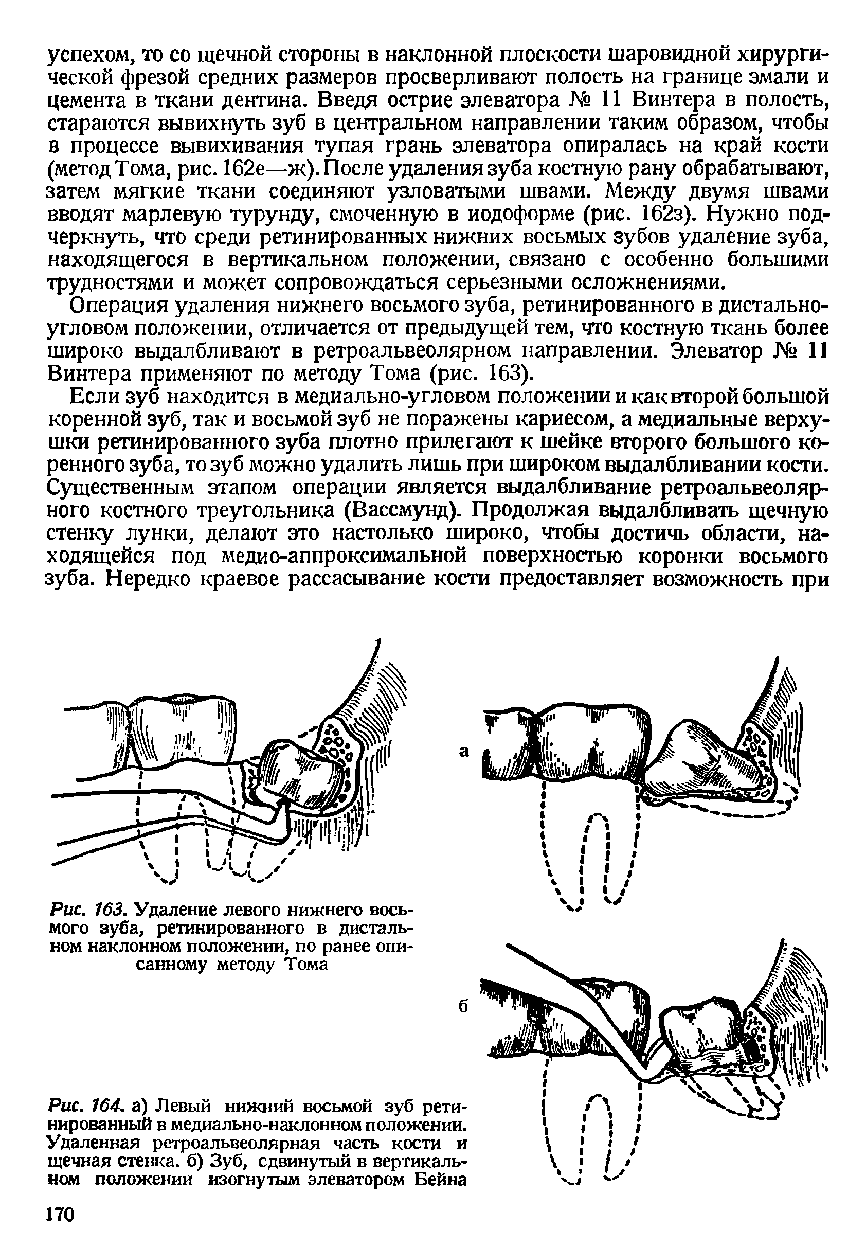 Рис. 163. Удаление левого нижнего восьмого зуба, ретинированного в дистальном наклонном положении, по ранее описанному методу Тома...