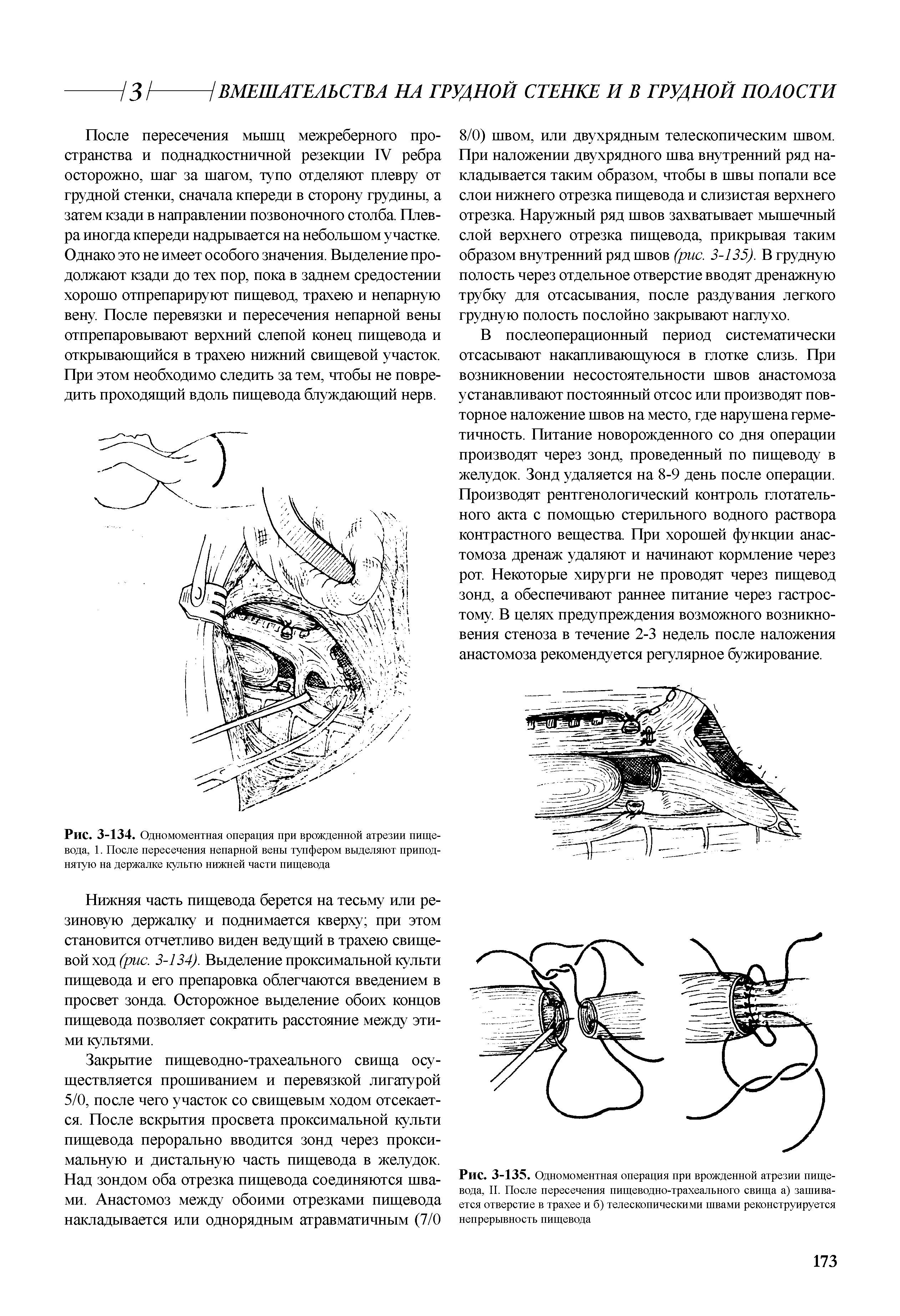 Рис. 3-135. Одномоментная операция при врожденной атрезии пищевода, II. После пересечения пищеводно-трахеального свища а) зашивается отверстие в трахее и б) телескопическими швами реконструируется непрерывность пищевода...