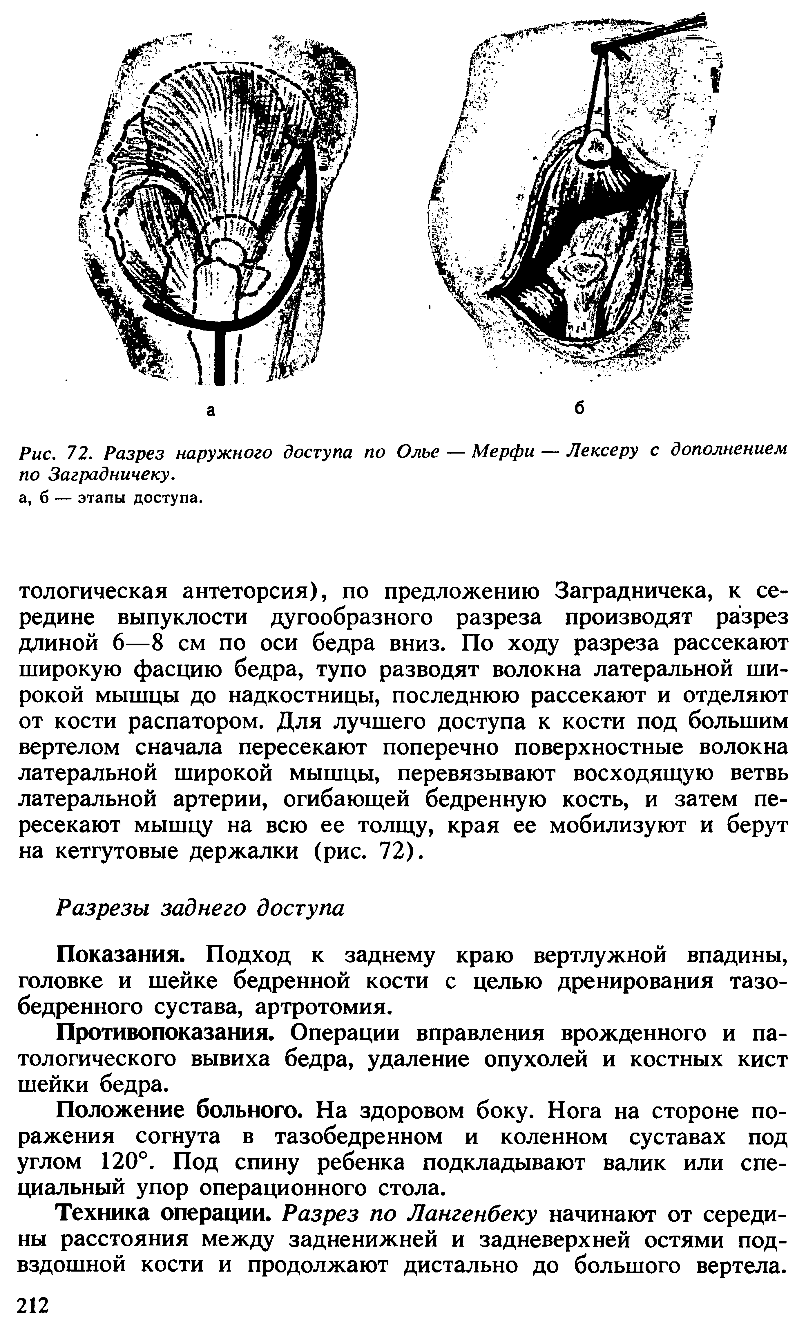 Рис. 72. Разрез наружного доступа по Олье — Мерфи — Лексеру с дополнением по Заградничеку.