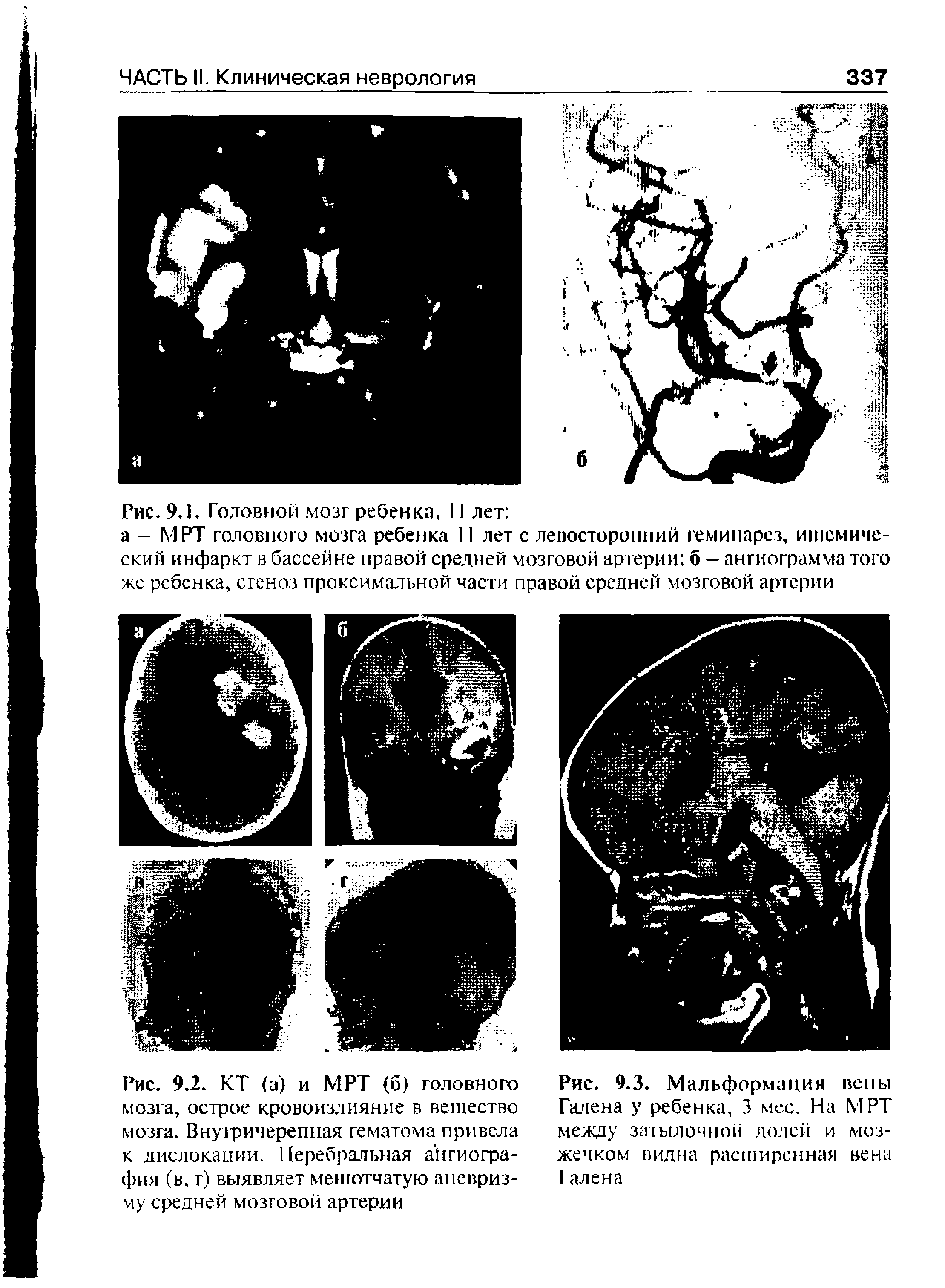 Рис. 9.2. КТ (а) и МРТ (б) головного мозга, острое кровоизлияние в вещество мозга. Внузричерепная гематома привела к дислокации. Церебральная ангиография (в. г) выявляет мешотчатую аневризму средней мозговой артерии...