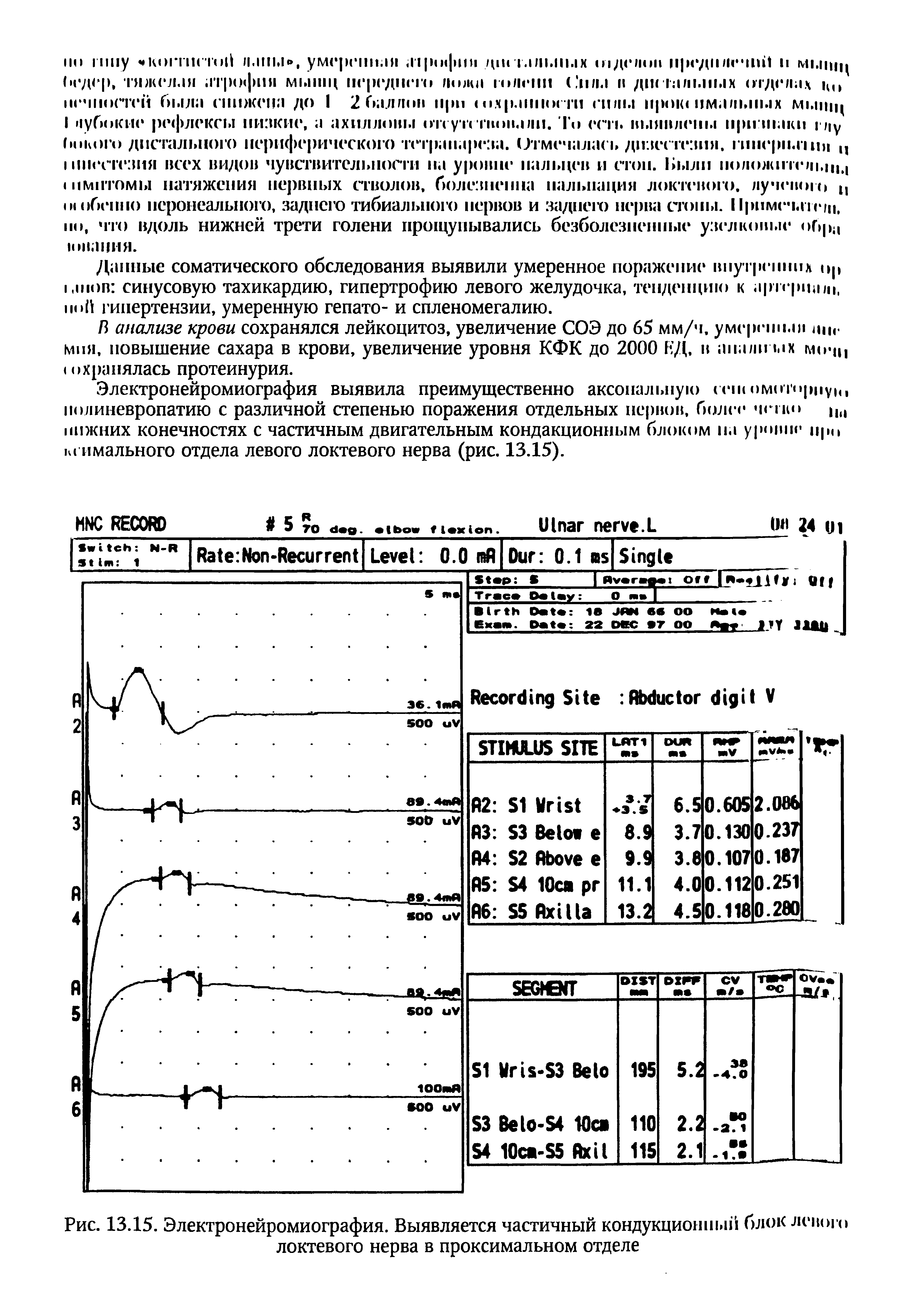 Рис. 13.15. Электронейромиография. Выявляется частичный кондукционный блок левого локтевого нерва в проксимальном отделе...