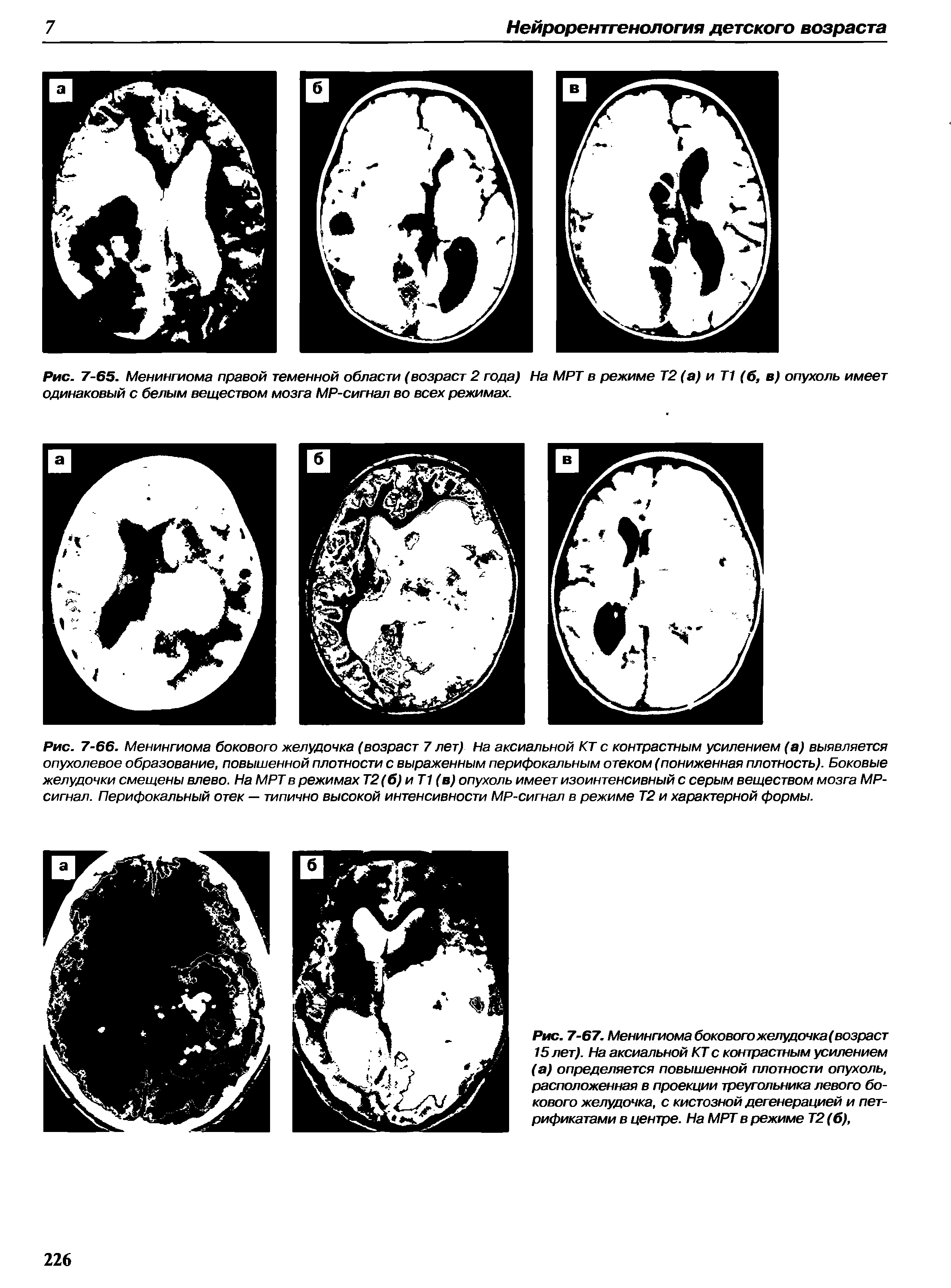 Рис. 7-67. Менингиома боковогожелудочка(возраст 15 лет). На аксиальной КТ с контрастным усилением (а) определяется повышенной плотности опухоль, расположенная в проекции треугольника левого бокового желудочка, с кистозной дегенерацией и петрификатами в центре. На МРТ в режиме Т2 (б),...