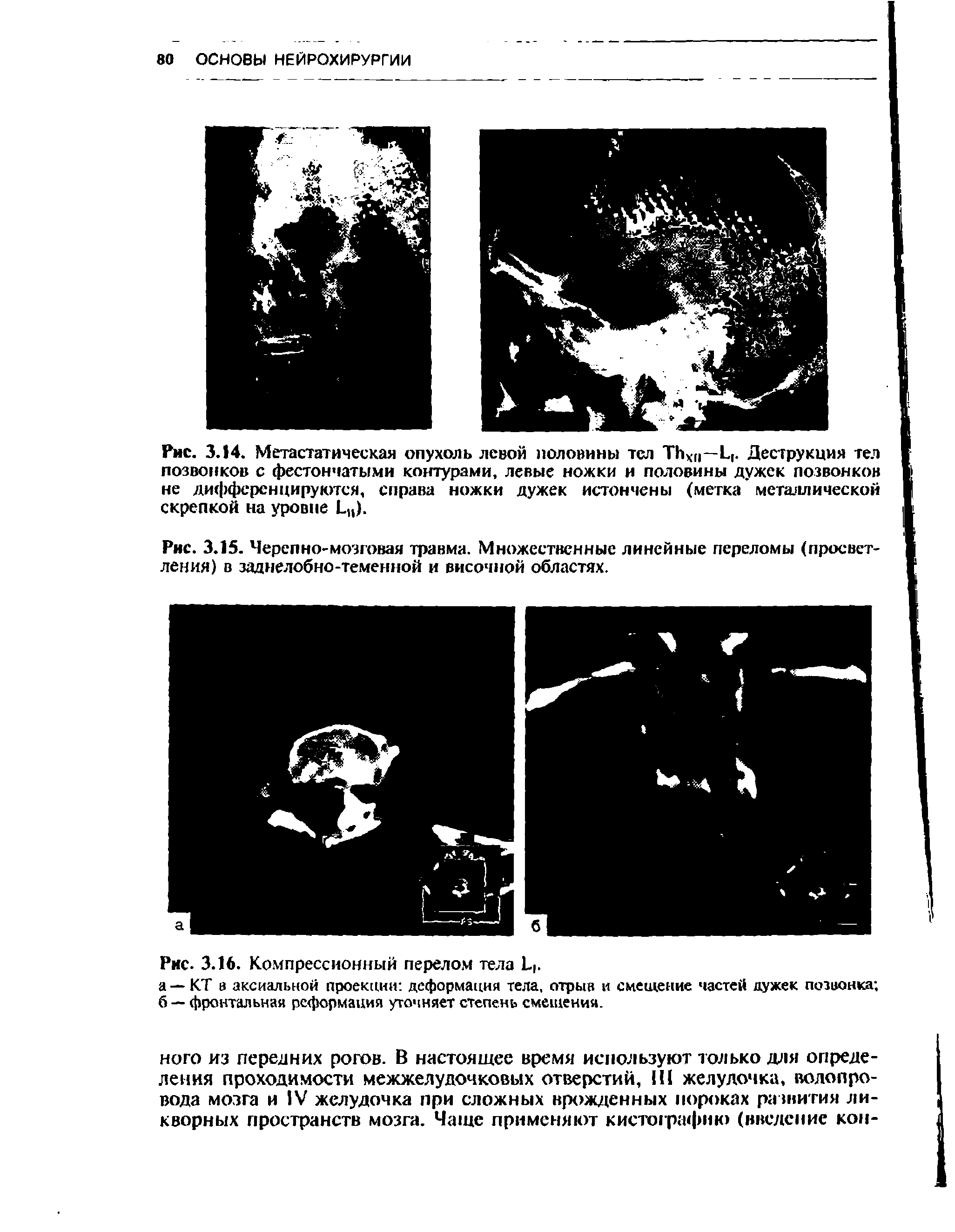 Рис. 3.15. Черепно-мозговая травма. Множественные линейные переломы (просветления) в заднелобно-теменной и височной областях.