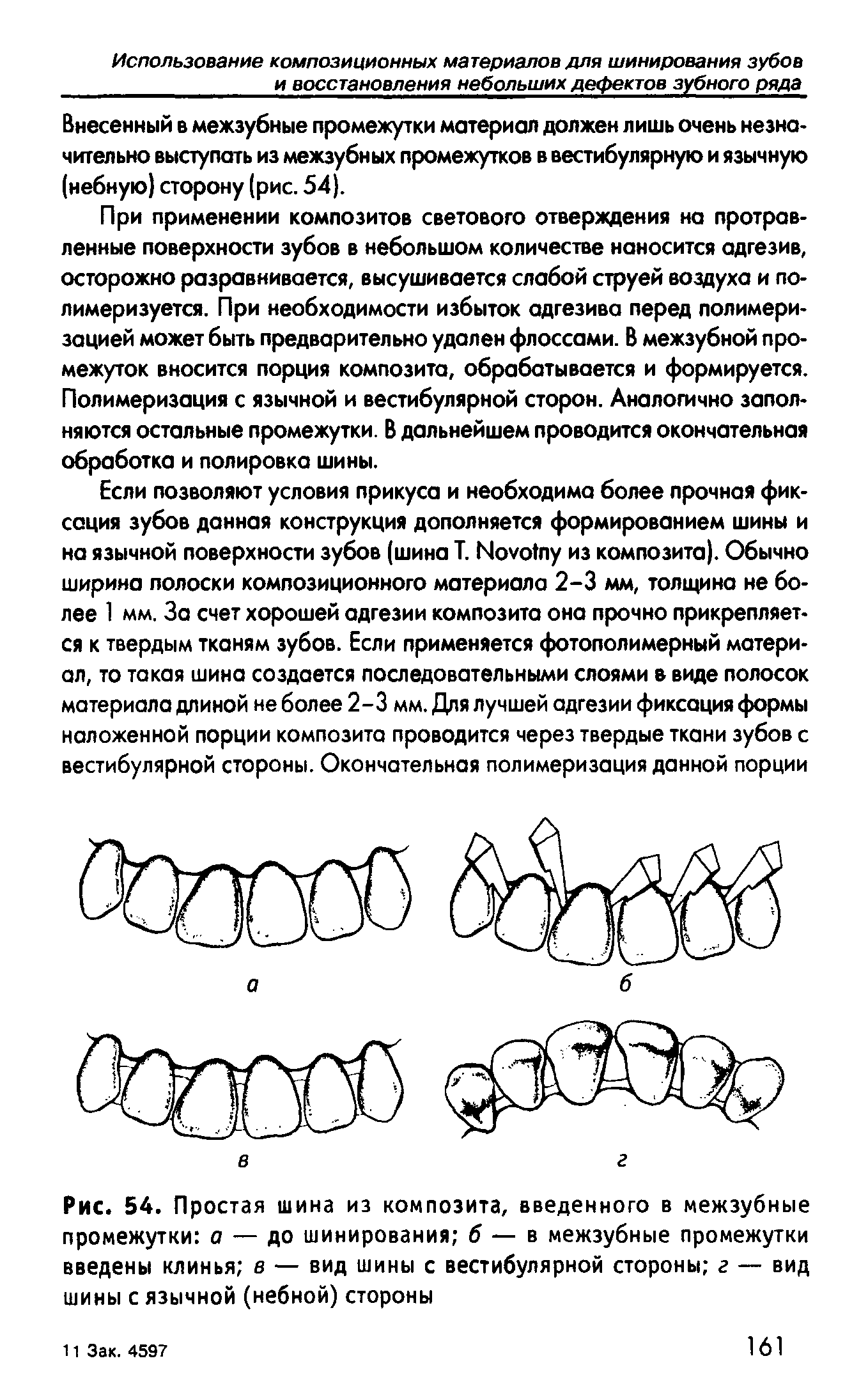 Рис. 54. Простая шина из композита, введенного в межзубные промежутки о — до шинирования б — в межзубные промежутки введены клинья в — вид шины с вестибулярной стороны г — вид шины с язычной (небной) стороны...