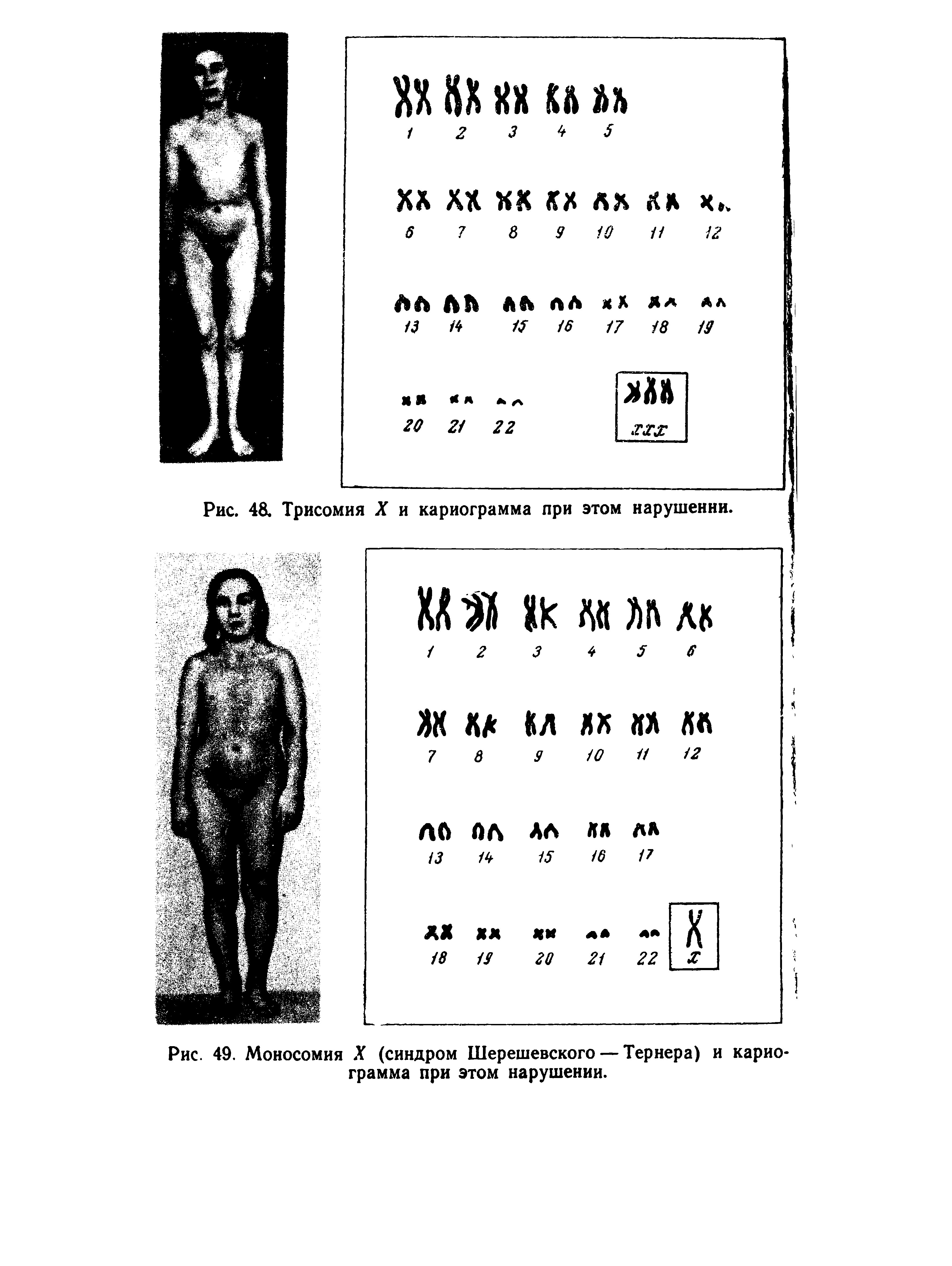 Рис. 49. Моносомия X (синдром Шерешевского — Тернера) и кариограмма при этом нарушении.