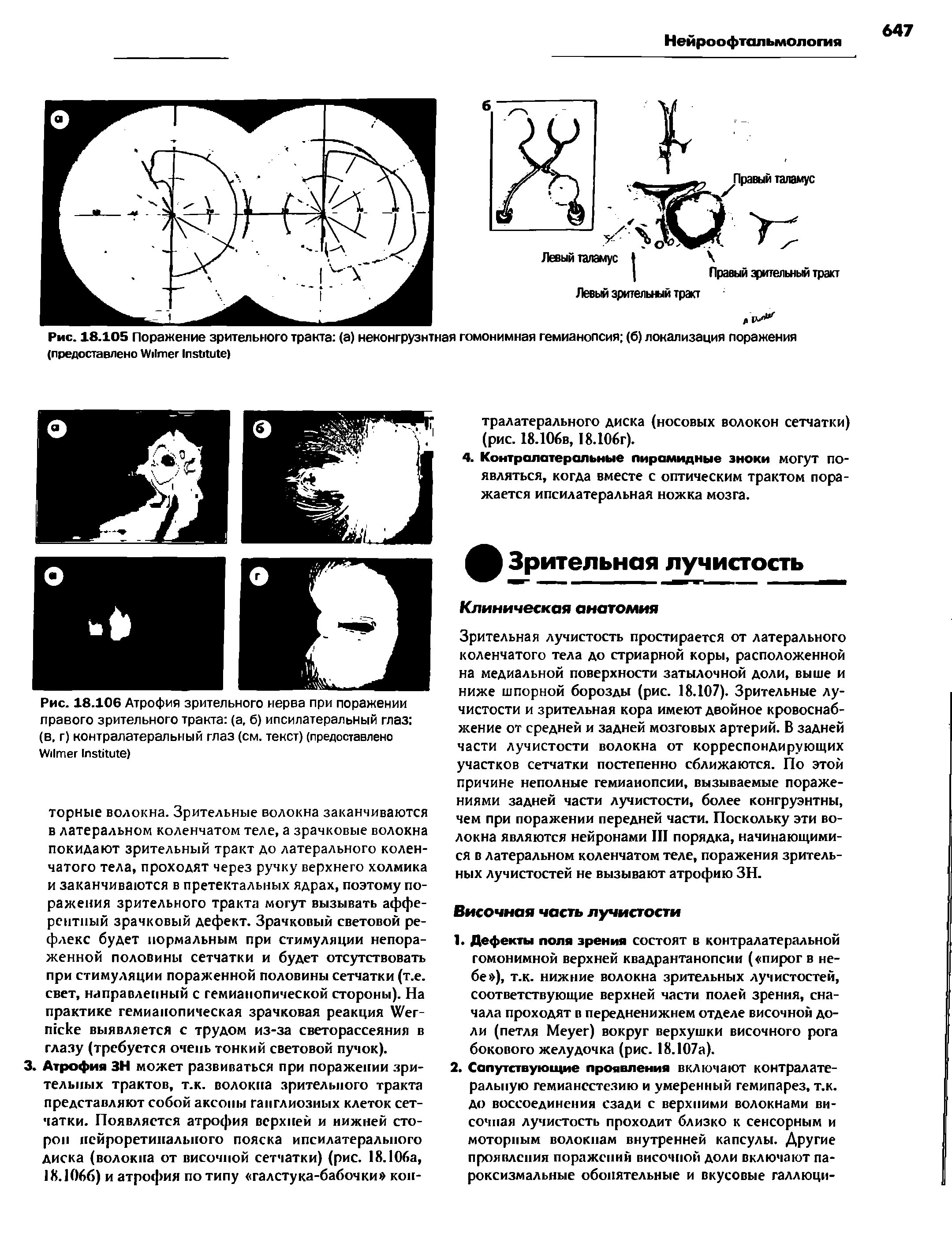 Рис. 18.106 Атрофия зрительного нерва при поражении правого зрительного тракта (а, б) ипсилатеральный глаз (в. г) контралатеральный глаз (см. текст) (предоставлено W I )...