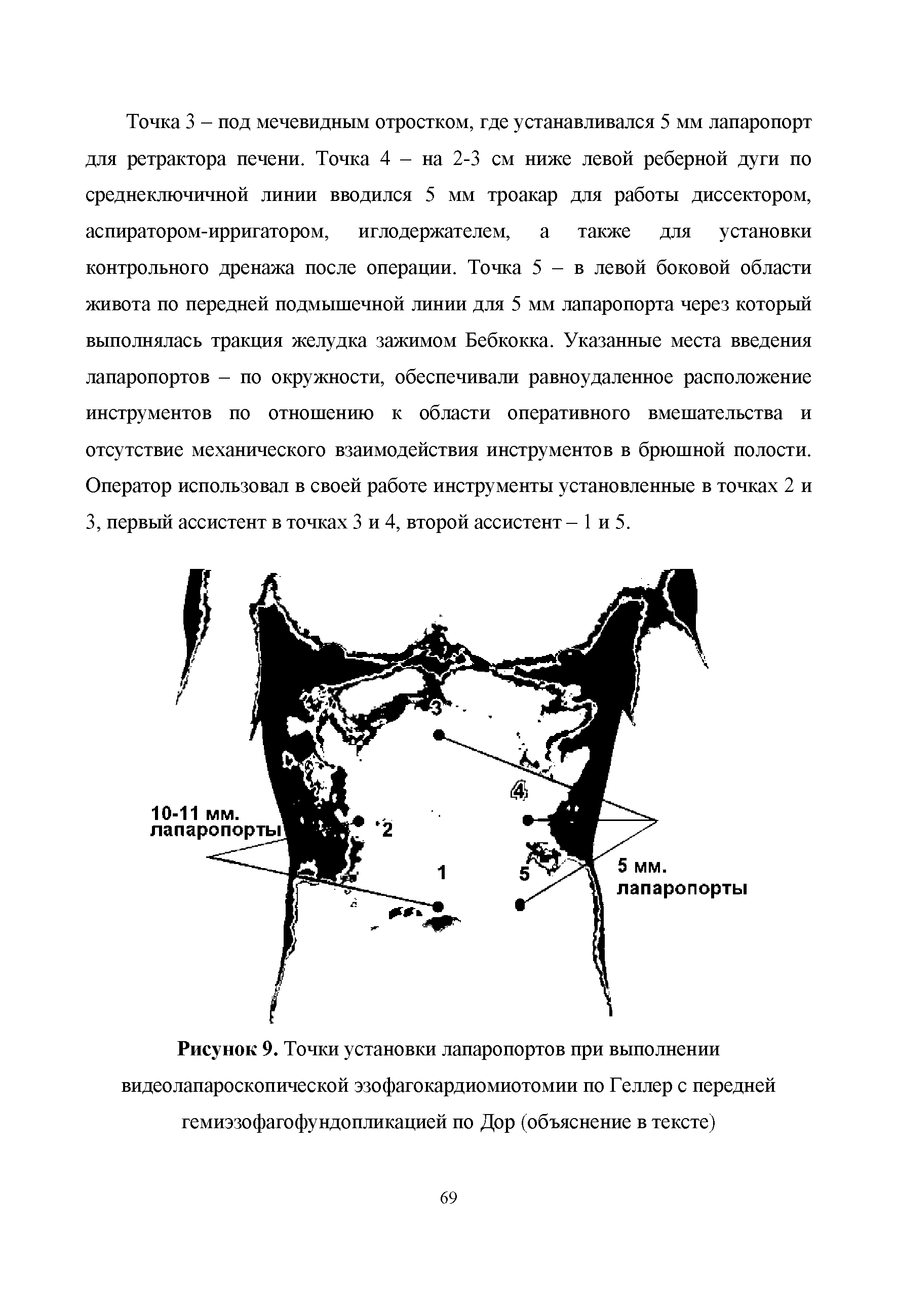 Рисунок 9. Точки установки лапаропортов при выполнении видеолапароскопической эзофагокардиомиотомии по Геллер с передней гемиэзофагофундопликацией по Дор (объяснение в тексте)...