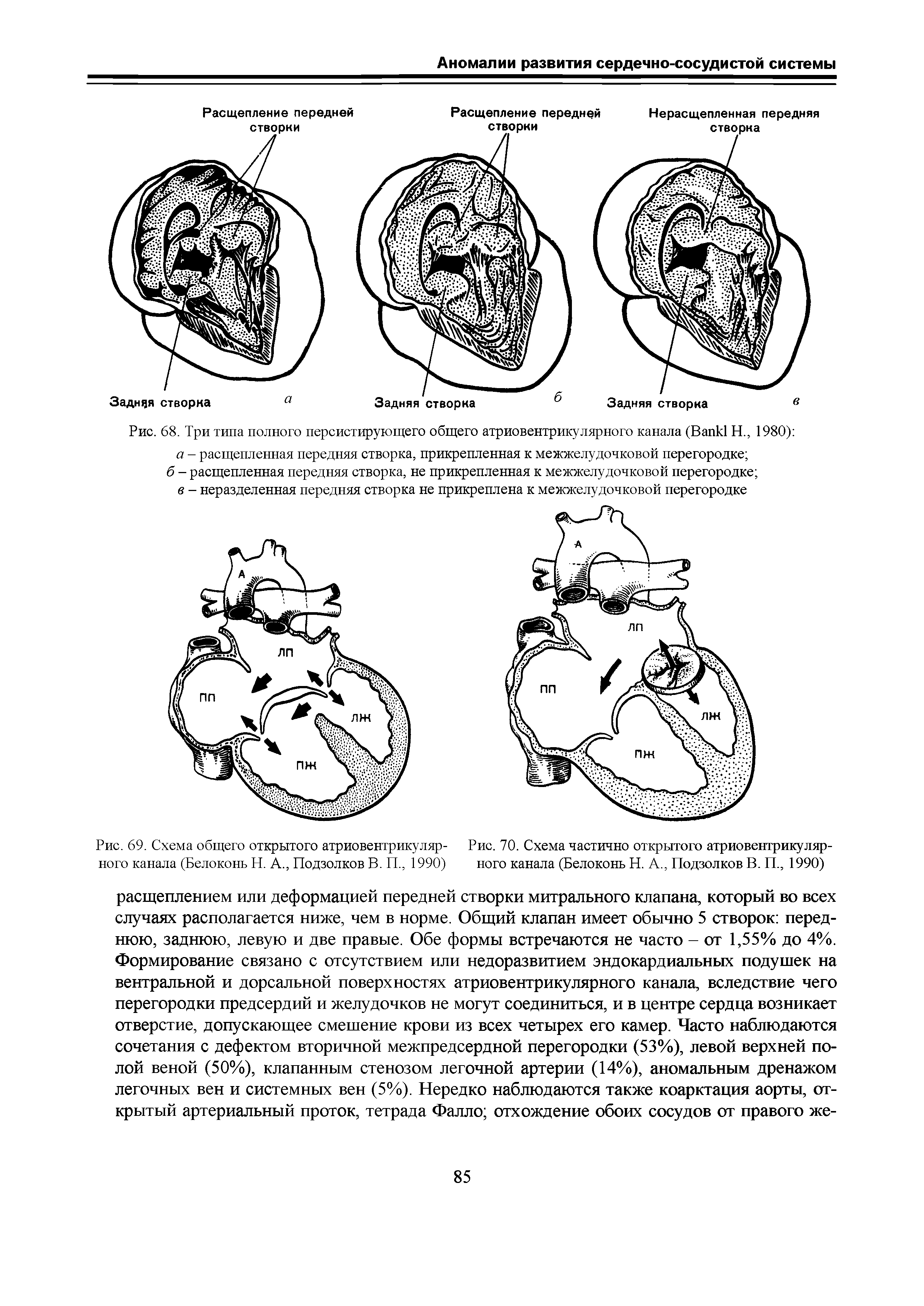 Рис. 69. Схема общего открытого атриовентрикуляр- Рис. 70. Схема частично открытого атриовентрикулярного канала (Белоконь Н. А., Подзолков В. П., 1990) ного канала (Белоконь Н. А., Подзолков В. П., 1990)...