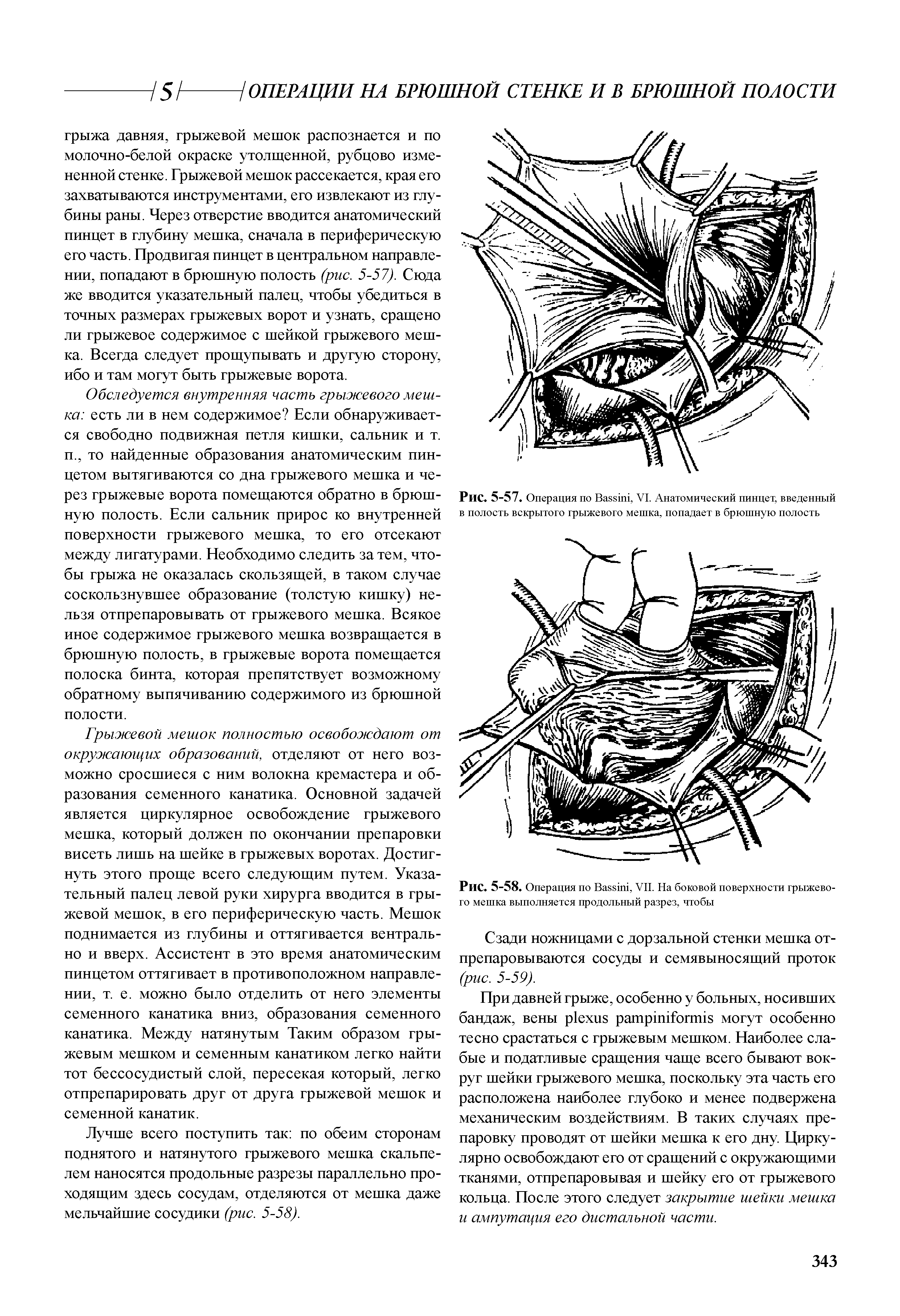 Рис. 5-58. Операция по B , VIL На боковой поверхности грыжевого мешка выполняется продольный разрез, чтобы...