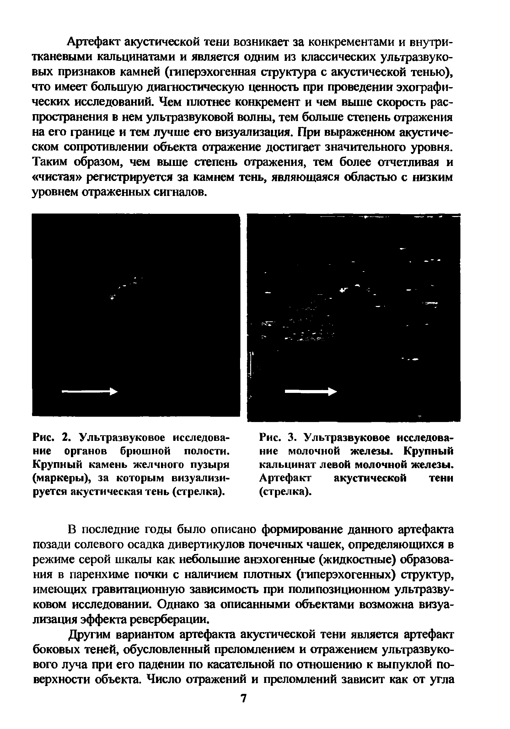 Рис. 2. Ультразвуковое исследование органов брюшной полости. Крупный камень желчного пузыря (маркеры), за которым визуализируется акустическая тень (стрелка).