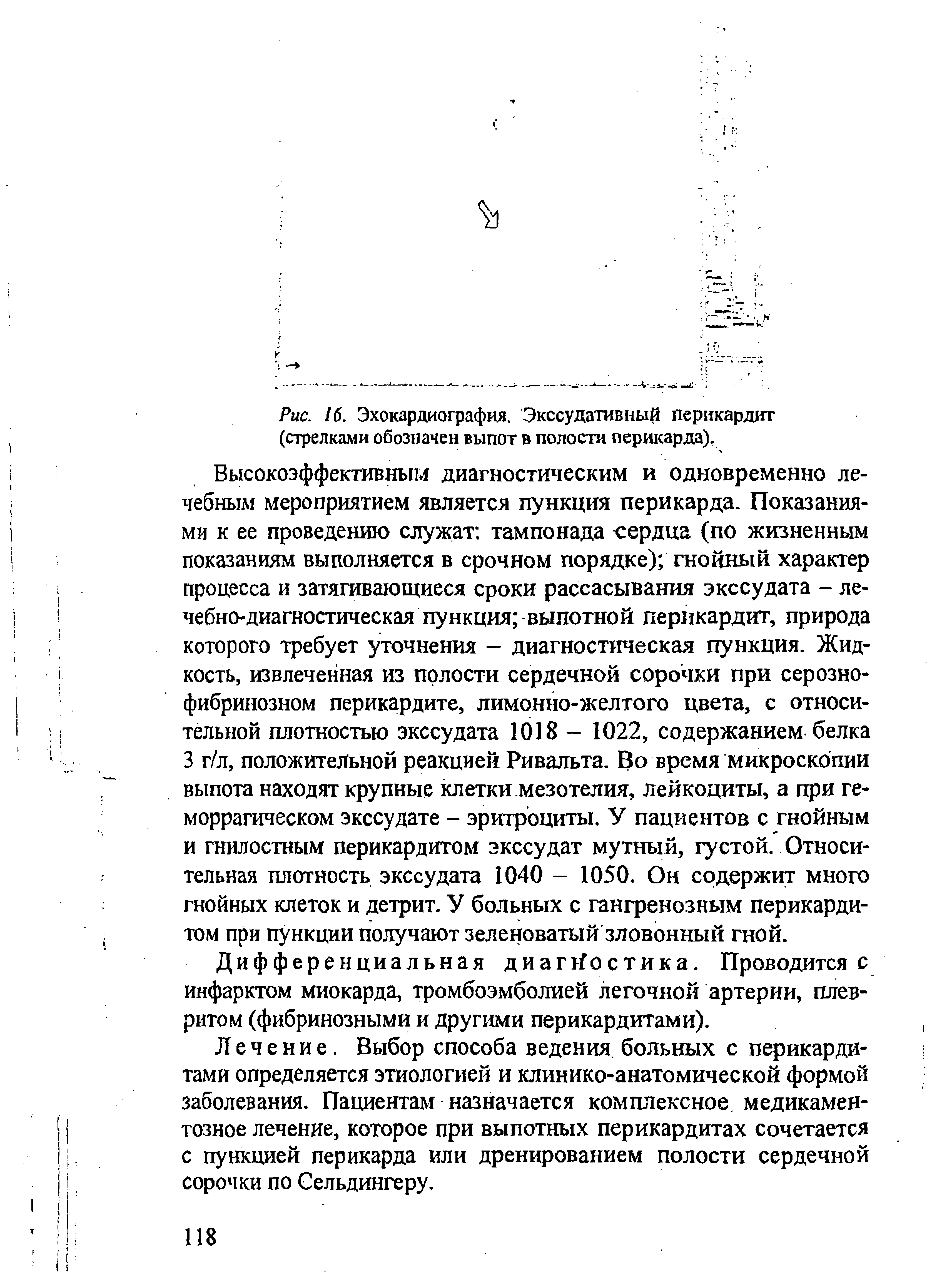 Рис. 16. Эхокардиография. Экссудативный перикардит (стрелками обозначен выпот в полости перикарда).