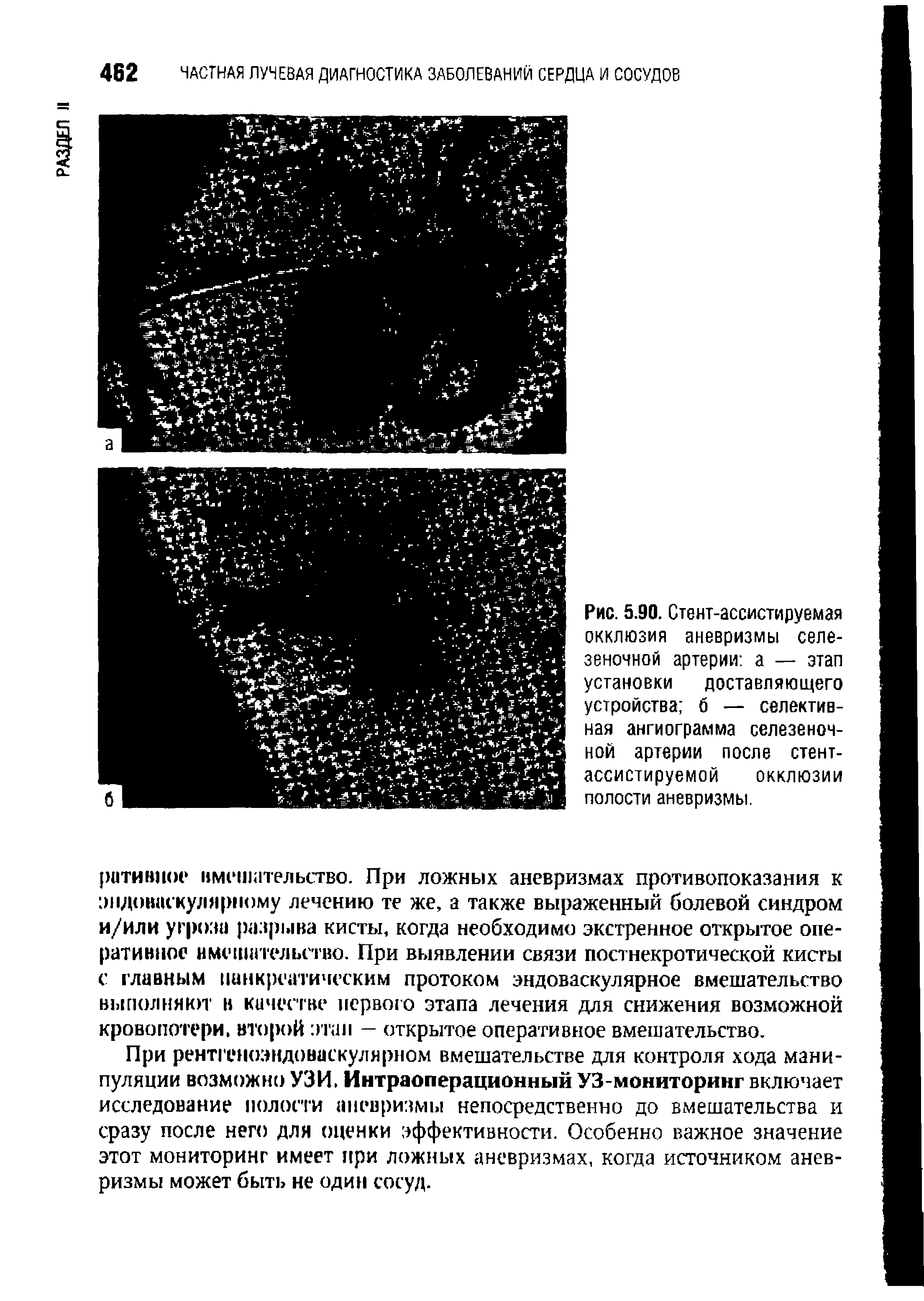 Рис. 5.90. Стент-ассистируемая окклюзия аневризмы селезеночной артерии а — этап установки доставляющего устройства б — селективная ангиограмма селезеночной артерии после стент-ассистируемой окклюзии полости аневризмы.