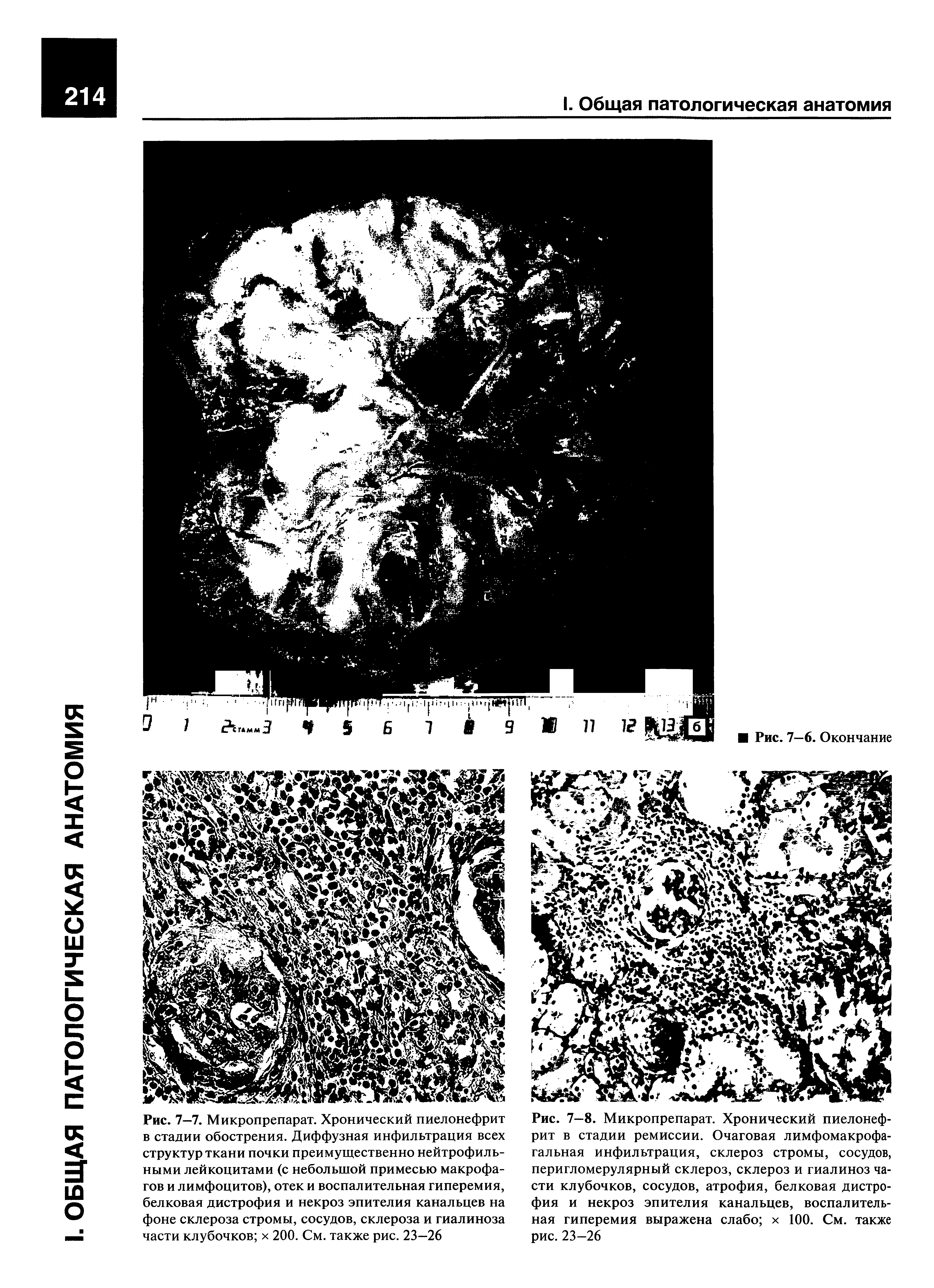Рис. 7-8. Микропрепарат. Хронический пиелонефрит в стадии ремиссии. Очаговая лимфомакрофагальная инфильтрация, склероз стромы, сосудов, перигломерулярный склероз, склероз и гиалиноз части клубочков, сосудов, атрофия, белковая дистрофия и некроз эпителия канальцев, воспалительная гиперемия выражена слабо х 100. См. также рис. 23—26...