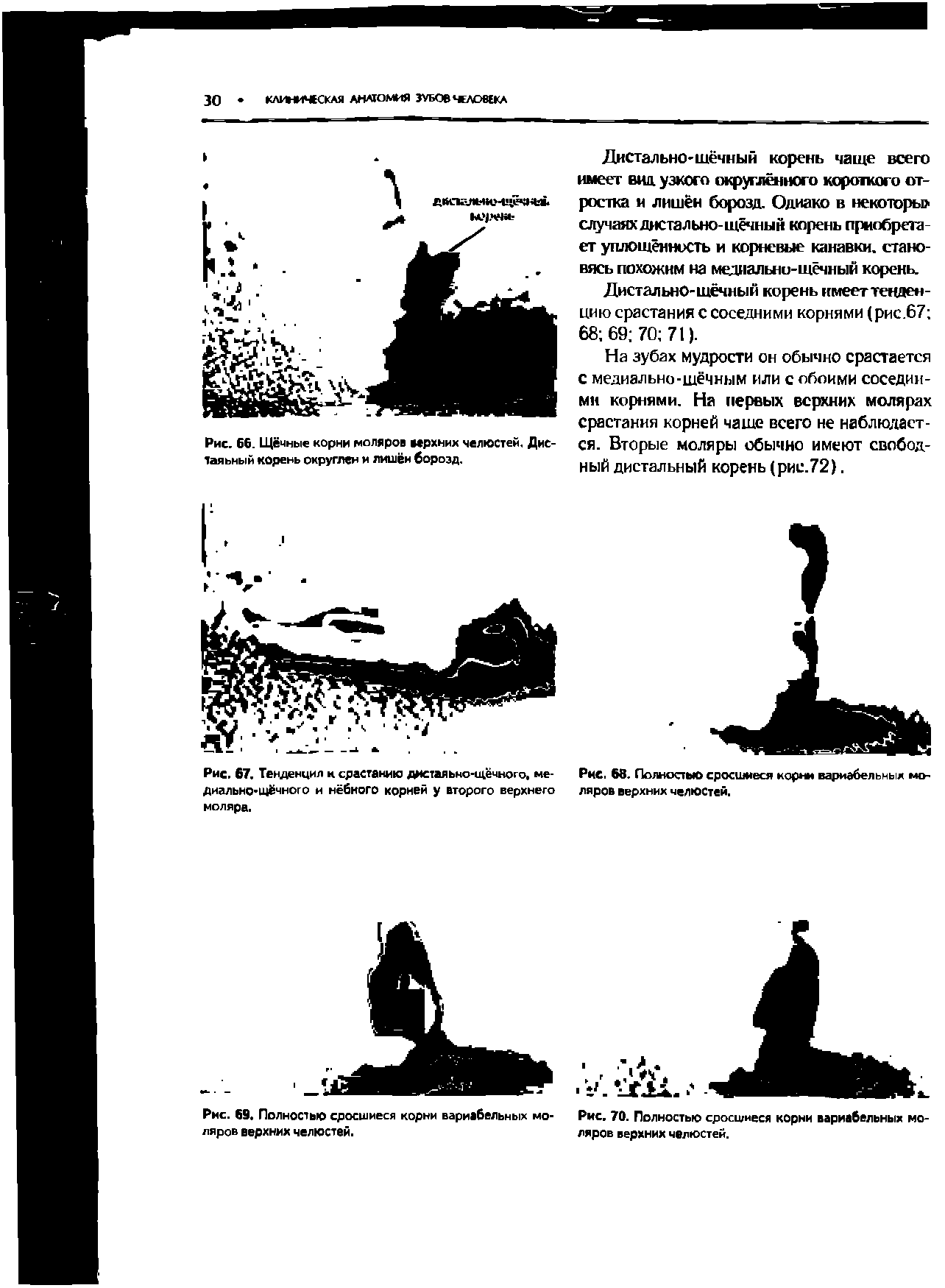 Рис. 66. Щёчные корни моляров верхних челюстей. Дис-Таяьный корень округлен и лишён борозд.