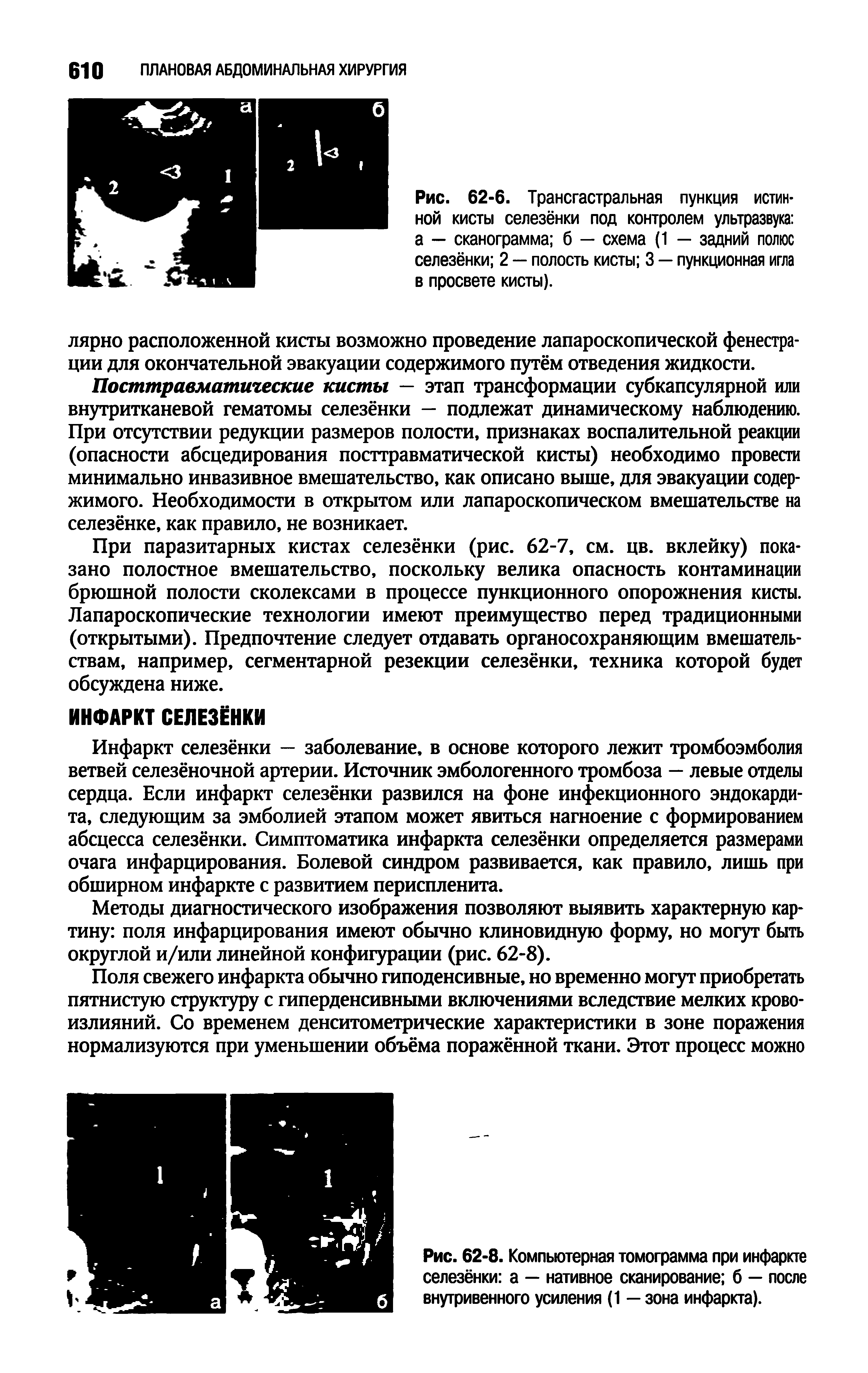 Рис. 62-6. Трансгастральная пункция истинной кисты селезёнки под контролем ультразвука а — сканограмма б — схема (1 — задний полюс селезёнки 2 — полость кисты 3 — пункционная игла в просвете кисты).