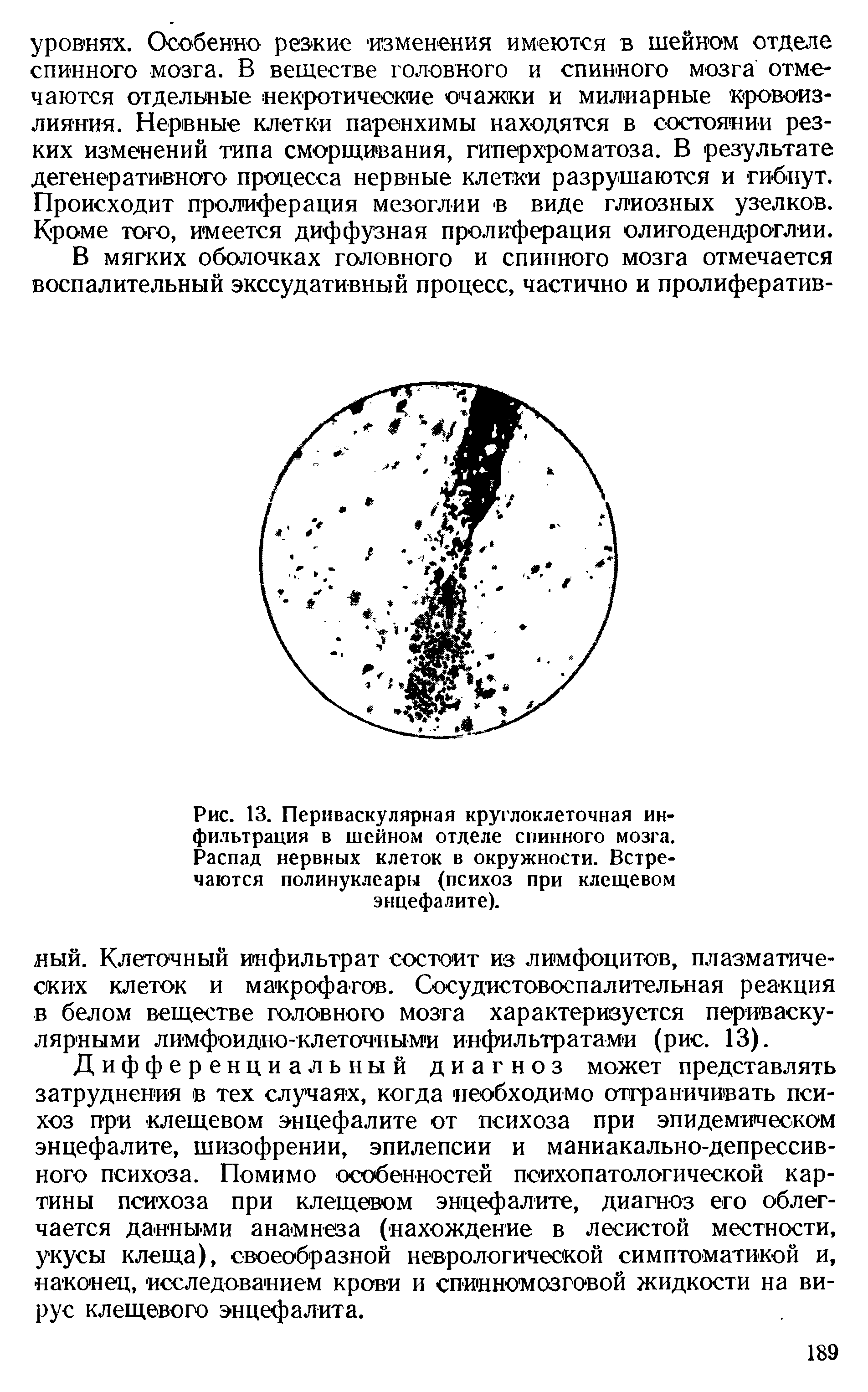 Рис. 13. Периваскулярная круглоклеточная инфильтрация в шейном отделе спинного мозга. Распад нервных клеток в окружности. Встречаются полинуклеары (психоз при клещевом энцефалите).