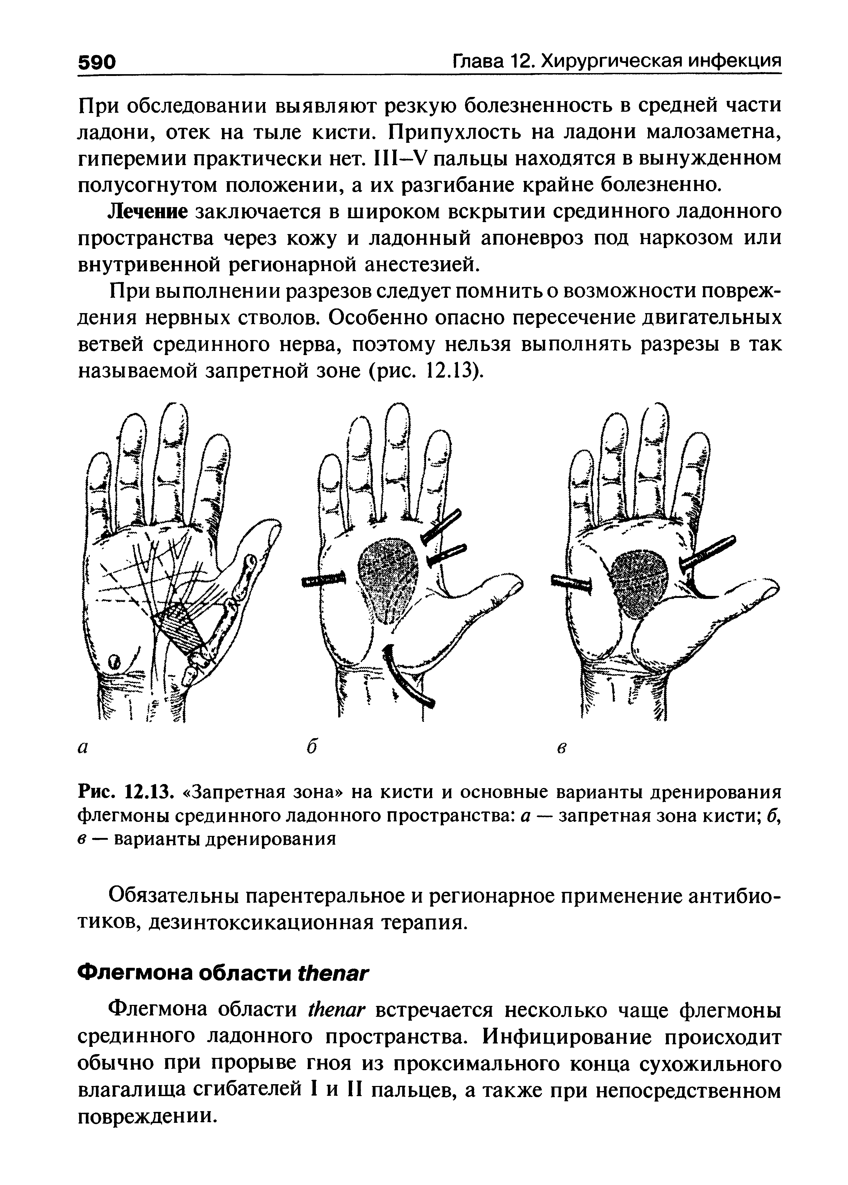 Рис. 12.13. Запретная зона на кисти и основные варианты дренирования флегмоны срединного ладонного пространства а — запретная зона кисти б, в — варианты дренирования...