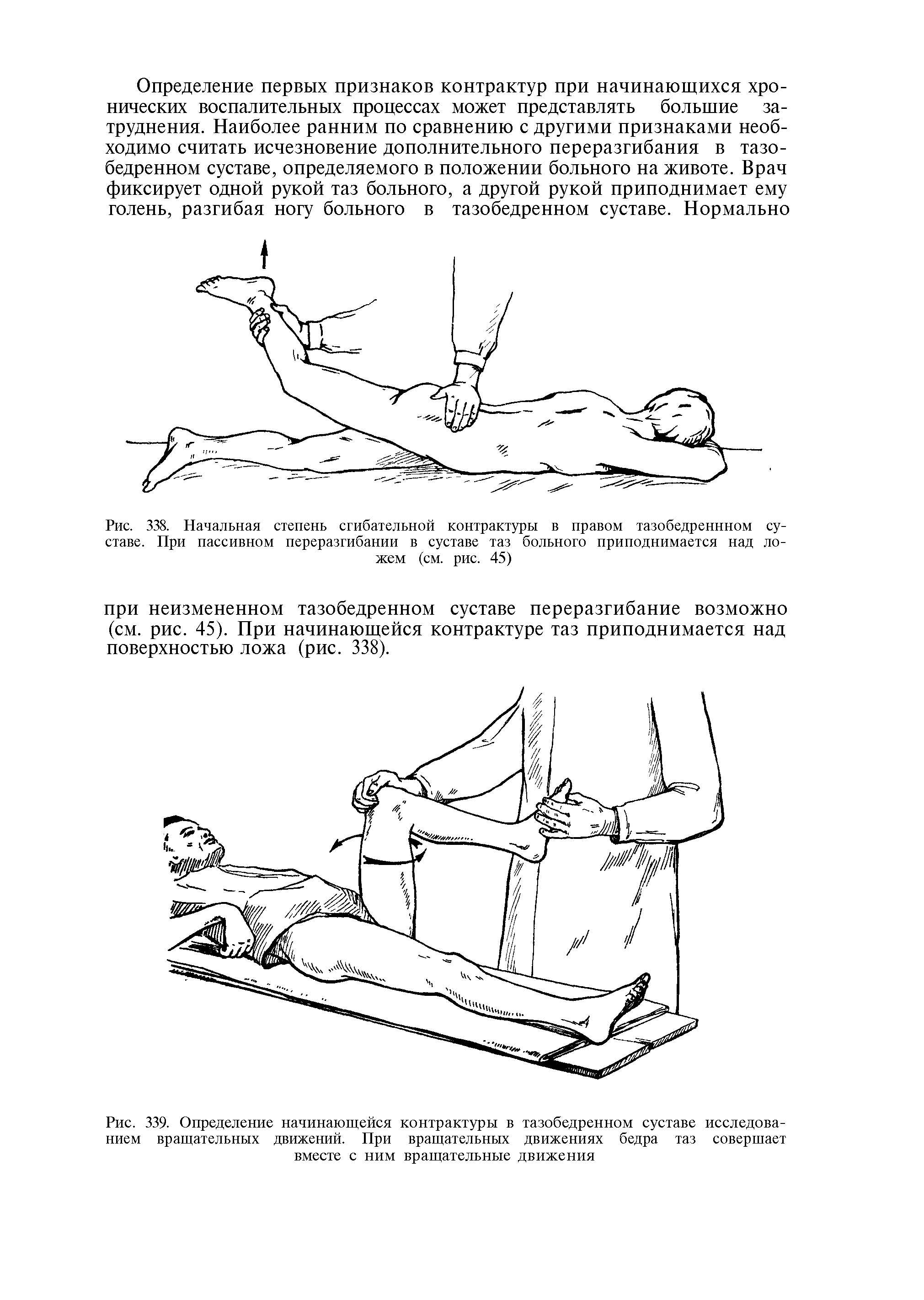 Рис. 339. Определение начинающейся контрактуры в тазобедренном суставе исследованием вращательных движений. При вращательных движениях бедра таз совершает вместе с ним вращательные движения...