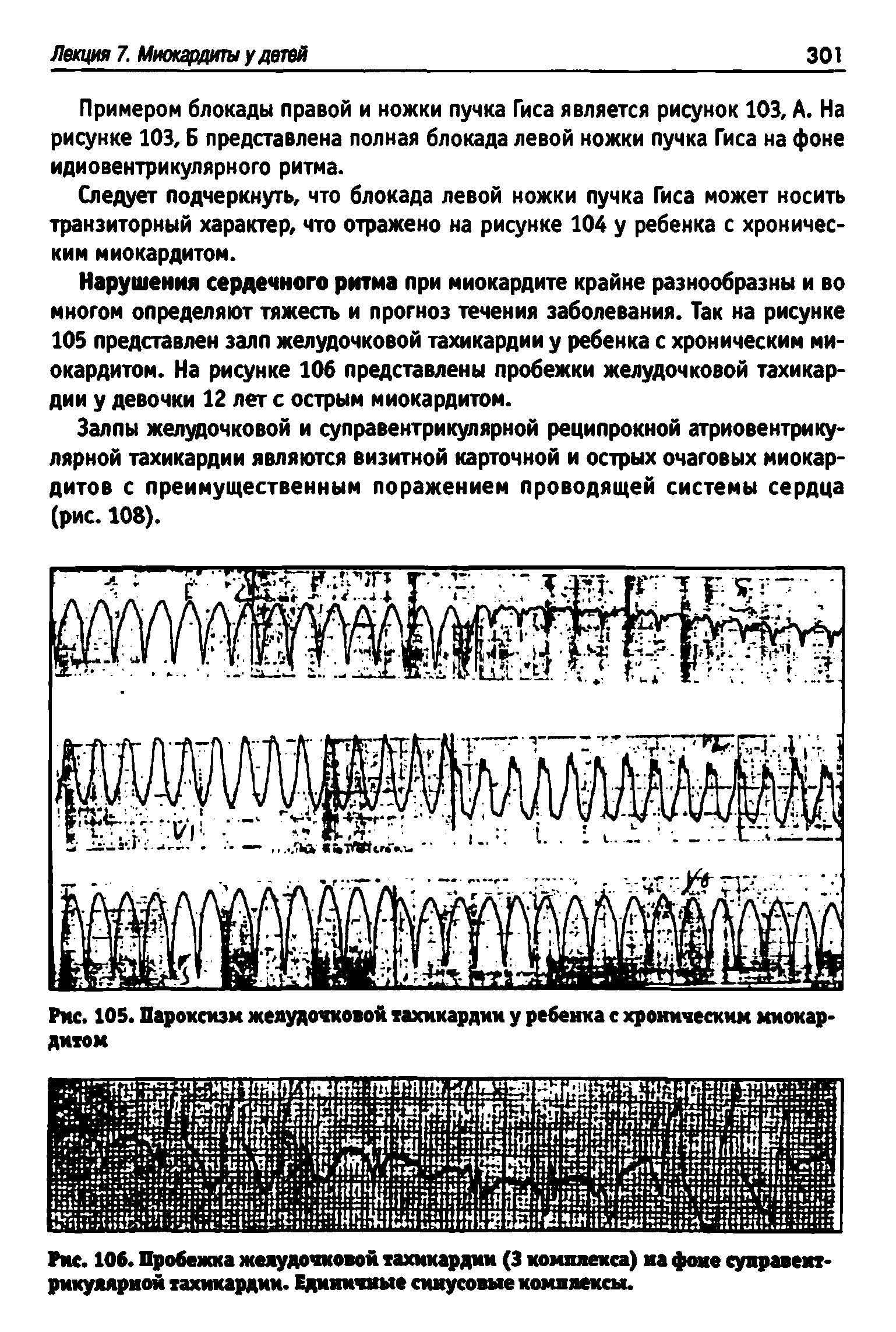 Рис. 105. Пароксизм желудочковой тахикардии у ребенка с хроническим миокардитом...