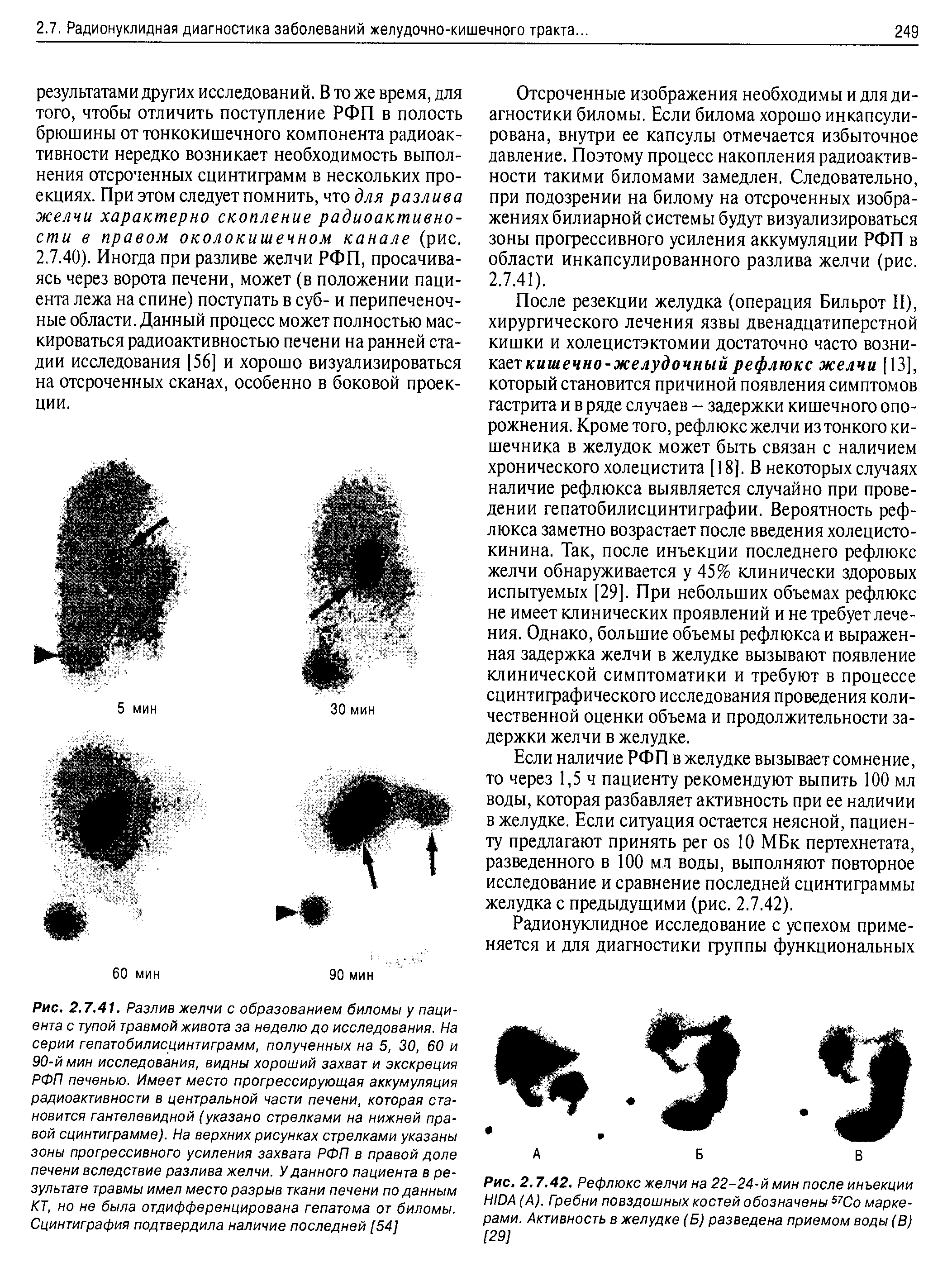 Рис. 2.7.42. Рефлюкс желчи на 22-24-й мин после инъекции HIDA (А). Гребни повздошных костей обозначены 57Со маркерами. Активность в желудке (Б) разведена приемом воды (В) [29]...