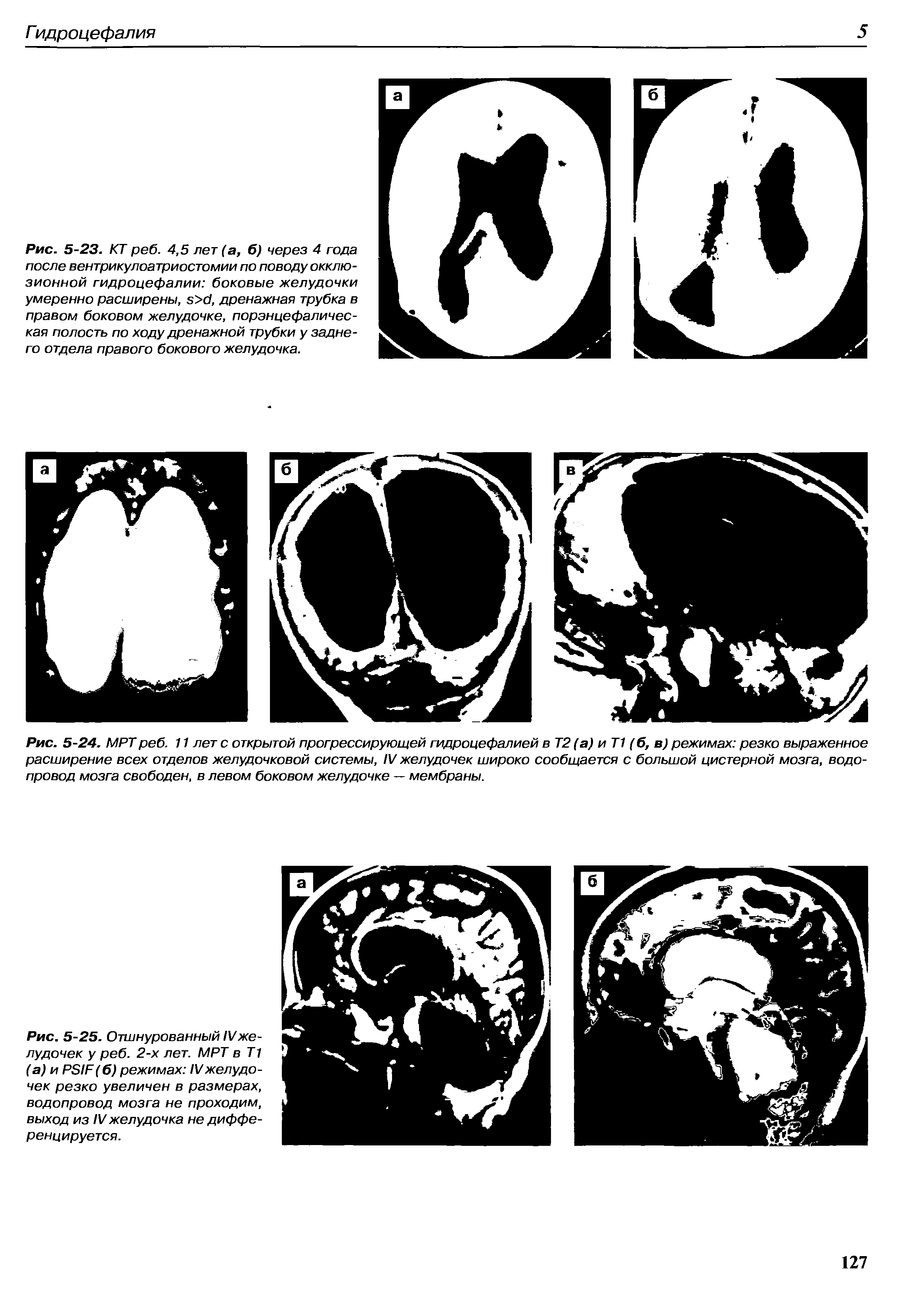 Рис. 5-24. МРТреб. 11 лет с открытой прогрессирующей гидроцефалией в Т2 (а) и Т1 (б, в) режимах резко выраженное расширение всех отделов желудочковой системы, IV желудочек широко сообщается с большой цистерной мозга, водопровод мозга свободен, в левом боковом желудочке — мембраны.
