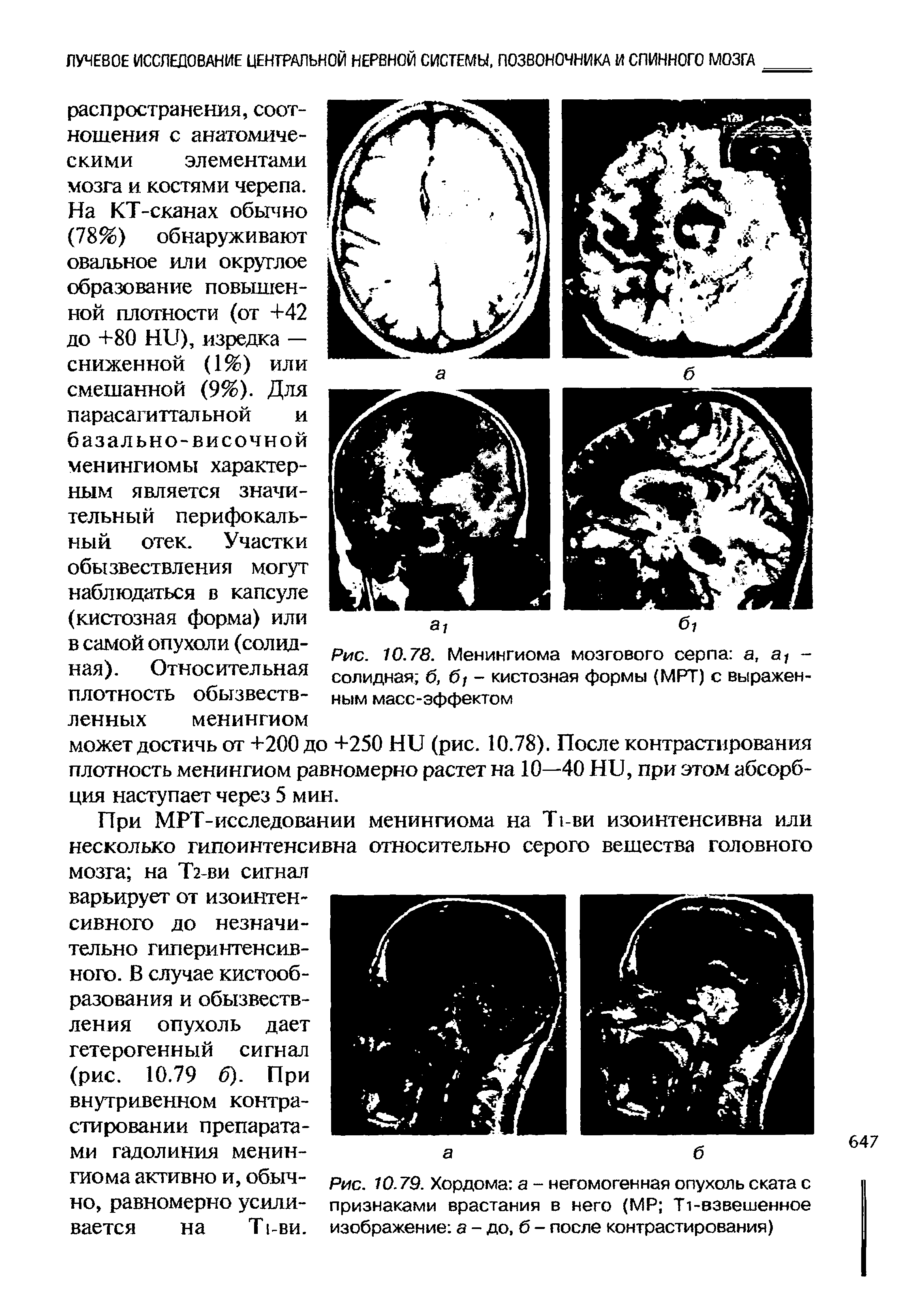 Рис. 10.79. Хордома а - негомогенная опухоль ската с признаками врастания в него (МР Т1-взвешенное изображение а - до, б - после контрастирования)...