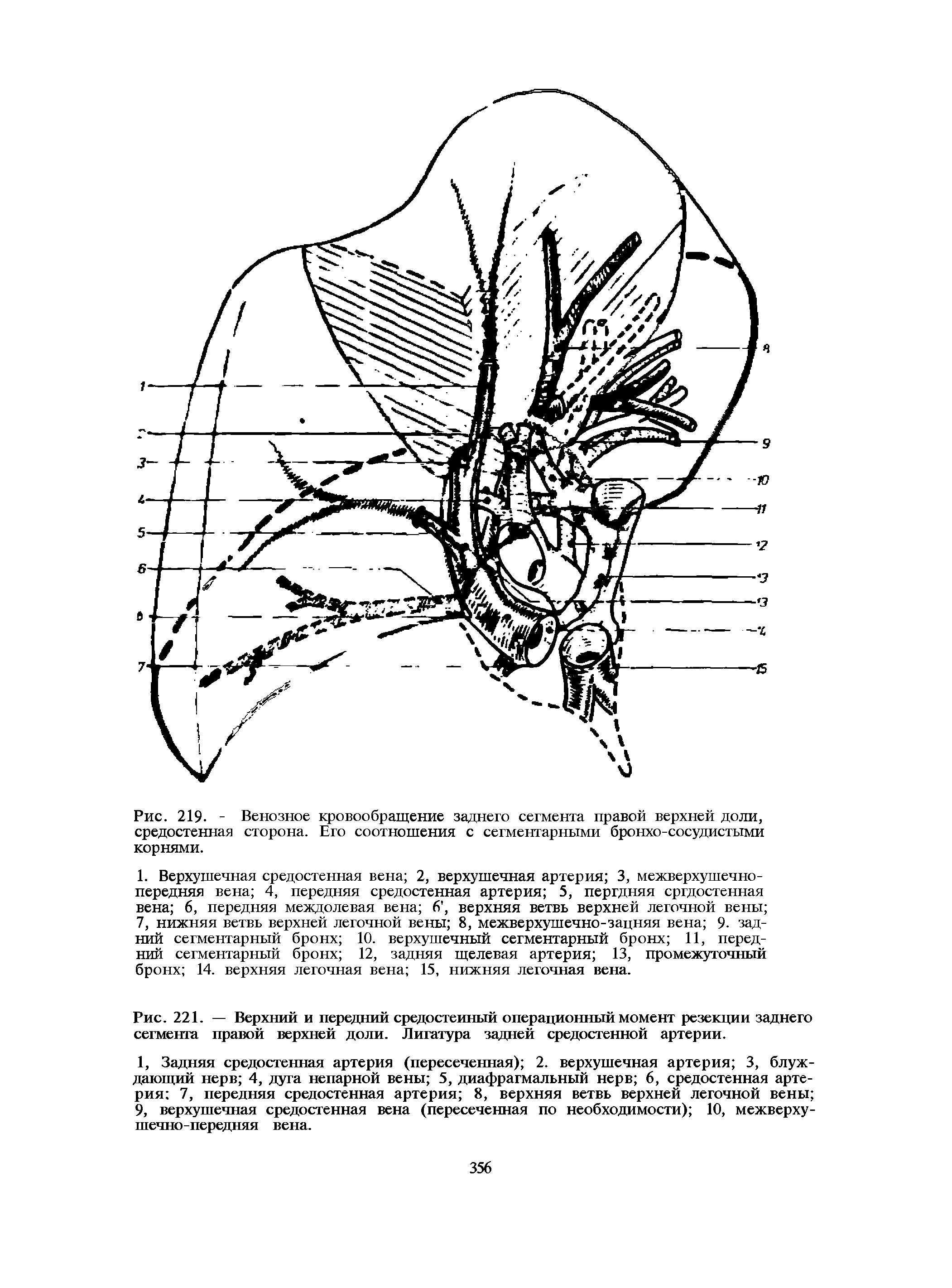 Рис. 221. — Верхний и передний средостенный операционный момент резекции заднего сегмента правой верхней доли. Лигатура задней средостенной артерии.