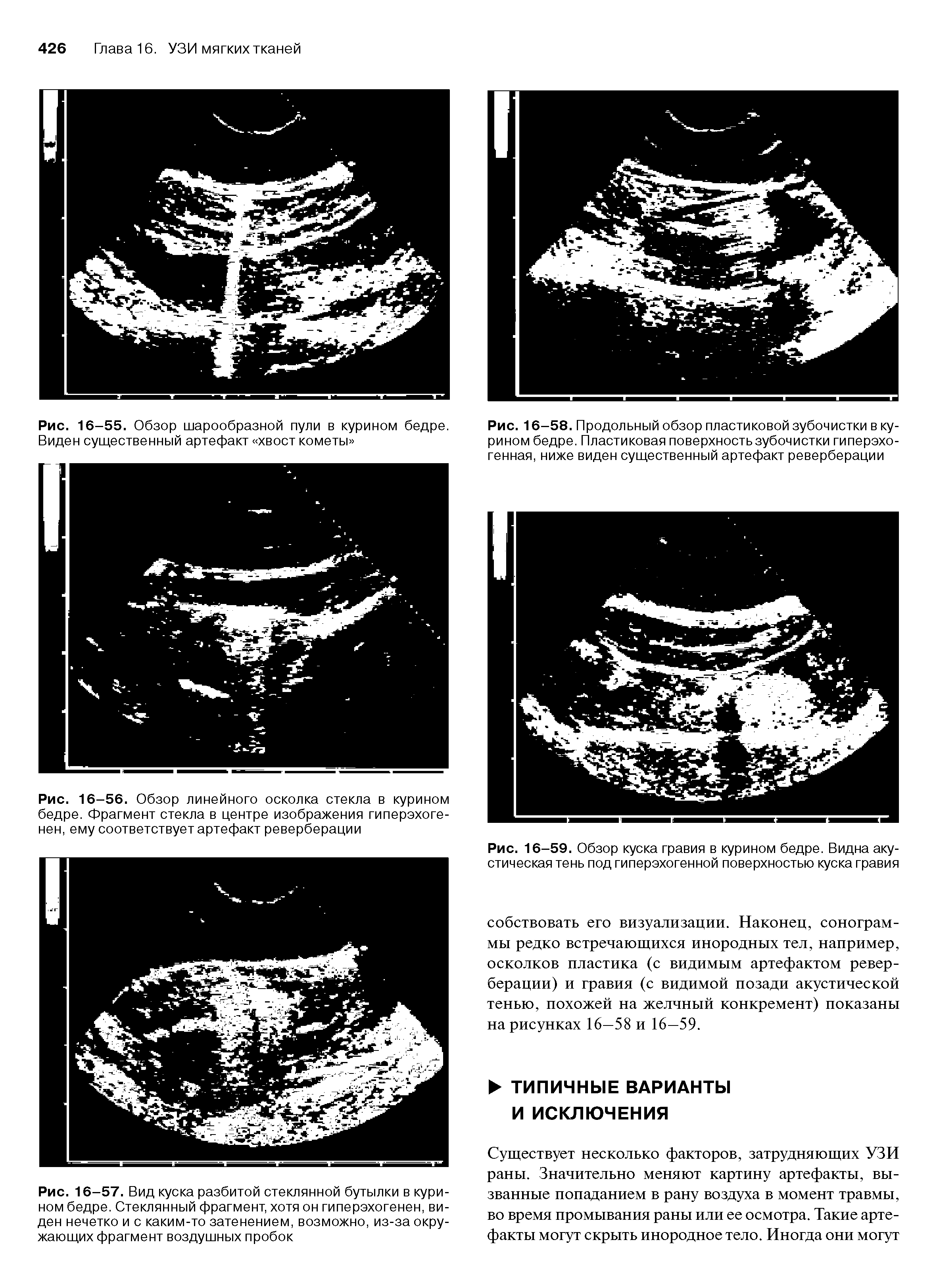 Рис. 16-56. Обзор линейного осколка стекла в курином бедре. Фрагмент стекла в центре изображения гиперэхоге-нен, ему соответствует артефакт реверберации...