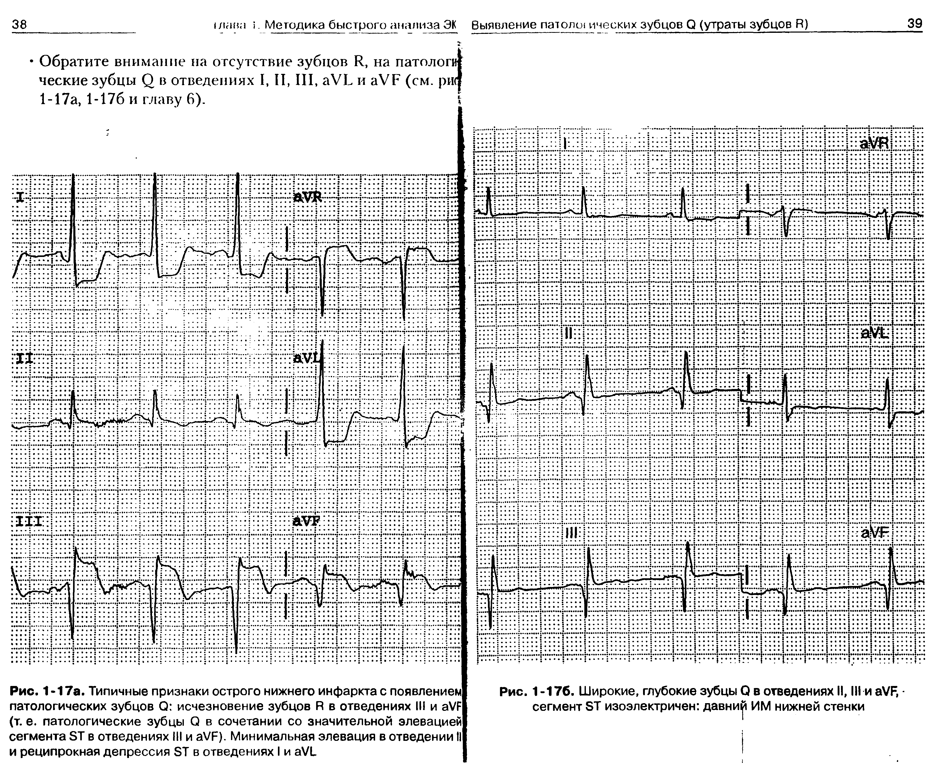 Рис. 1-17а. Типичные признаки острого нижнего инфаркта с появлением патологических зубцов Q исчезновение зубцов R в отведениях III и VF (т. е. патологические зубцы Q в сочетании со значительной элевацией сегмента ST в отведениях III и VF). Минимальная элевация в отведении II и реципрокная депрессия ST в отведениях I и VL...
