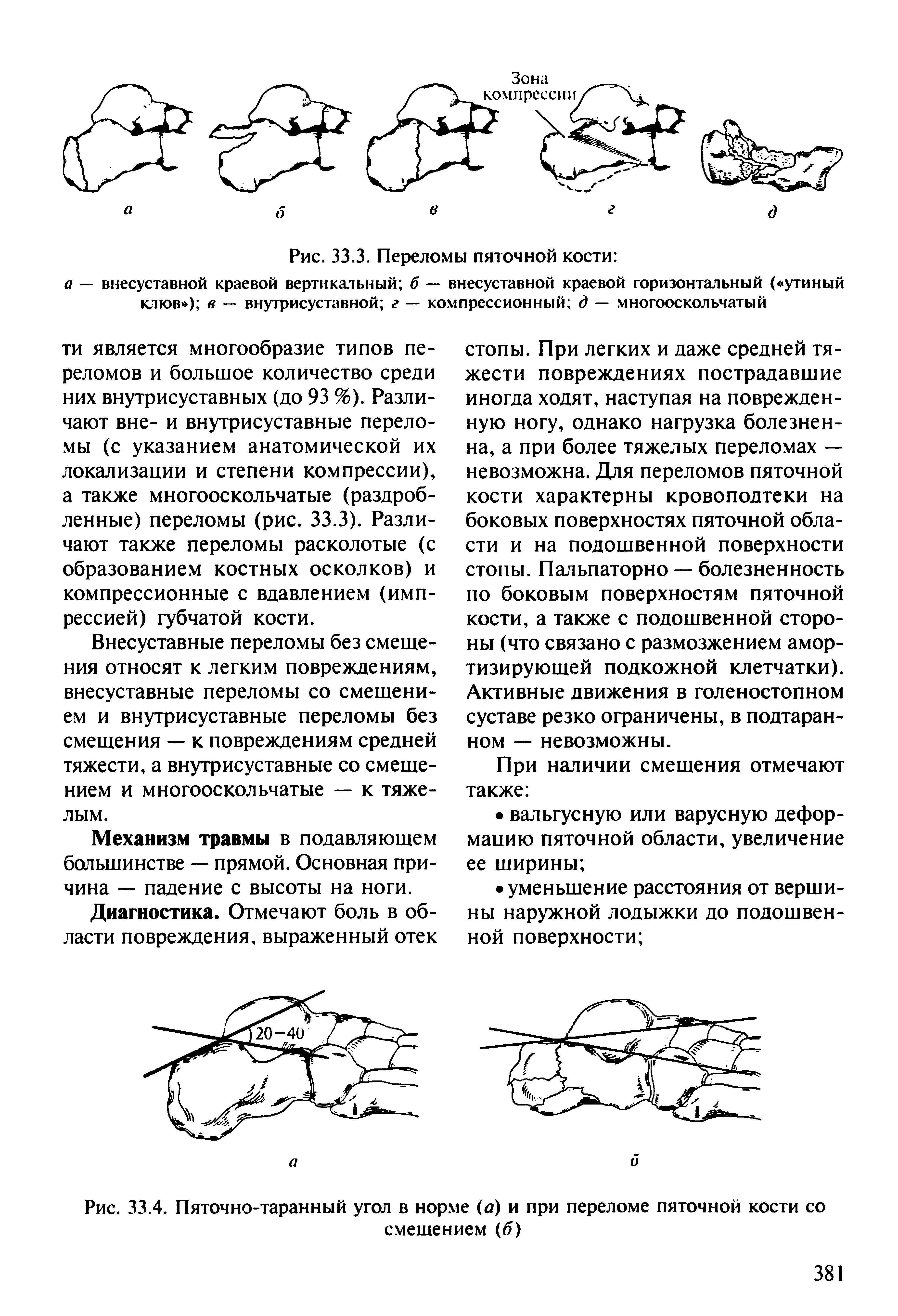 Рис. 33.4. Пяточно-таранный угол в норме (а) и при переломе пяточной кости со смещением (б)...