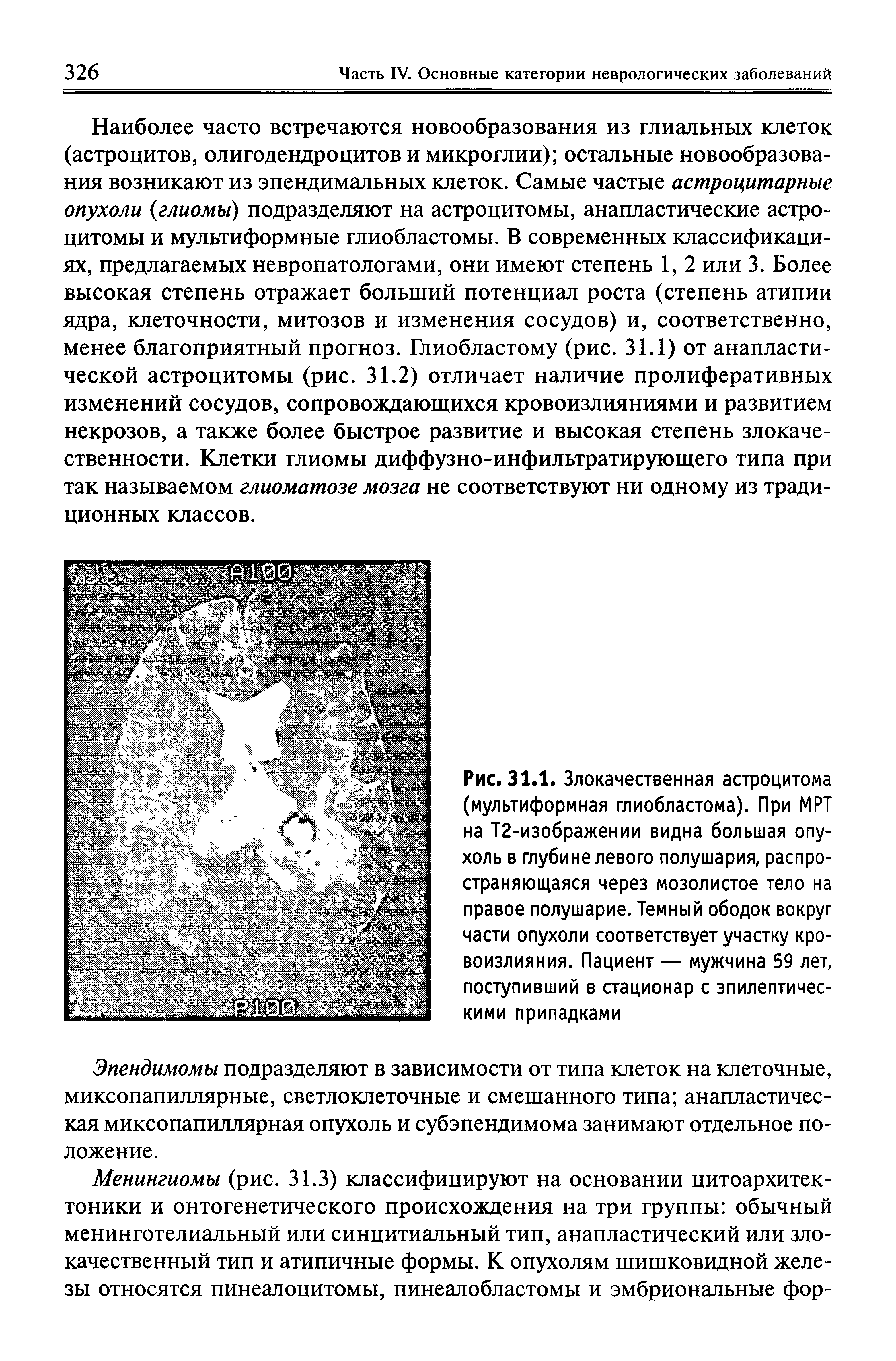 Рис. 31.1. Злокачественная астроцитома (мультиформная глиобластома). При МРТ на Т2-изображении видна большая опухоль в глубине левого полушария, распространяющаяся через мозолистое тело на правое полушарие. Темный ободок вокруг части опухоли соответствует участку кровоизлияния. Пациент — мужчина 59 лет, поступивший в стационар с эпилептическими припадками...