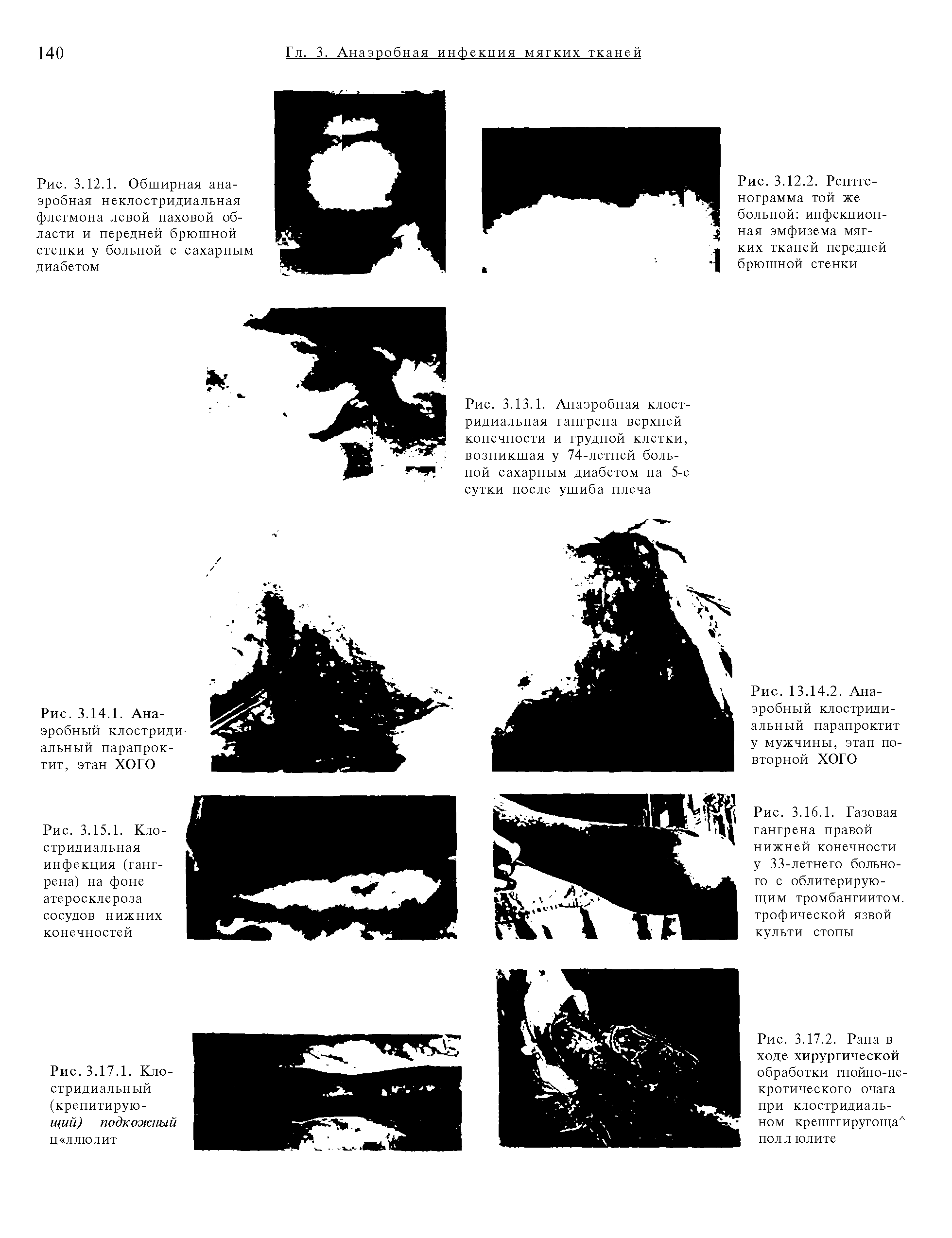 Рис. 3.14.1. Анаэробный клостриди альный парапроктит, этан ХОГО...