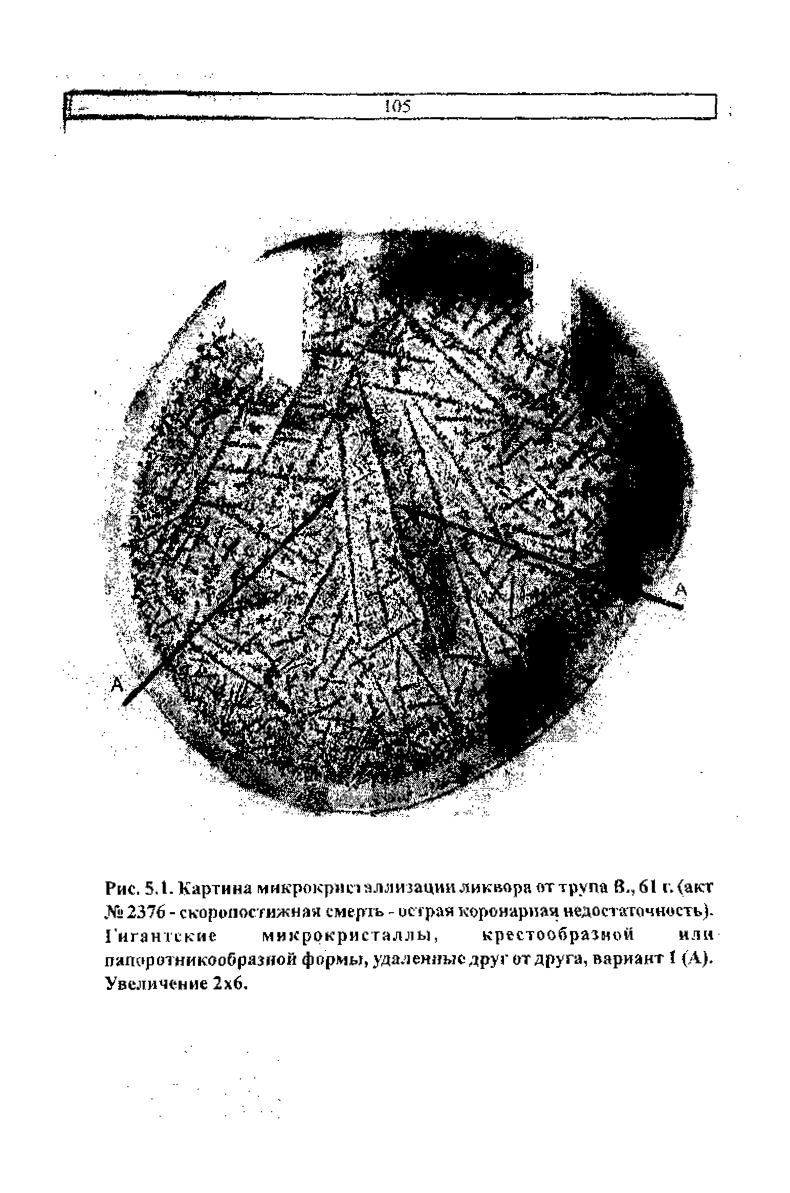 Рис. 5,1. Картина микрокристаллизации ликвора от трупа В., 61 г. (акт №2376 - скоропостижная смерть - острая коронарная недостаточность). Гигантские микрокристаллы, крестообразной или папоротникообразной формы, удаленные друг от друга, вариант 1 (А). Увеличение 2 6,...