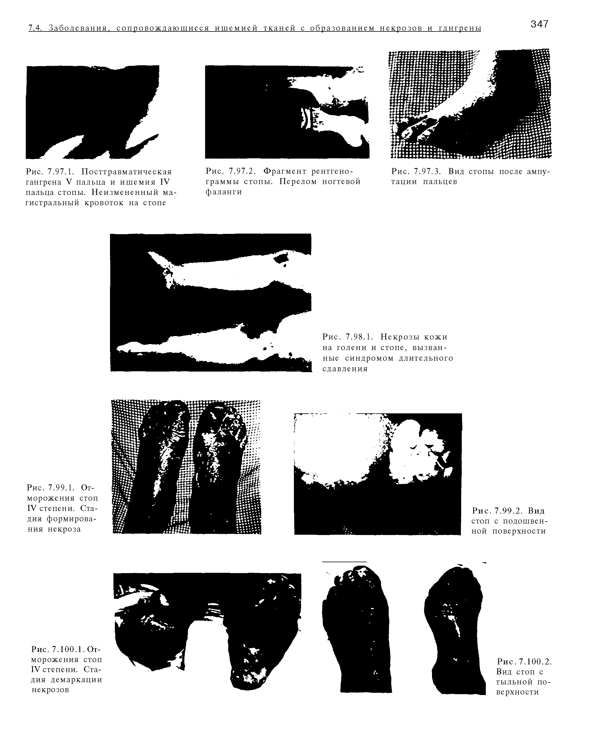 Рис. 7.99.1. Отморожения стоп IV степени. Стадия формирования некроза...