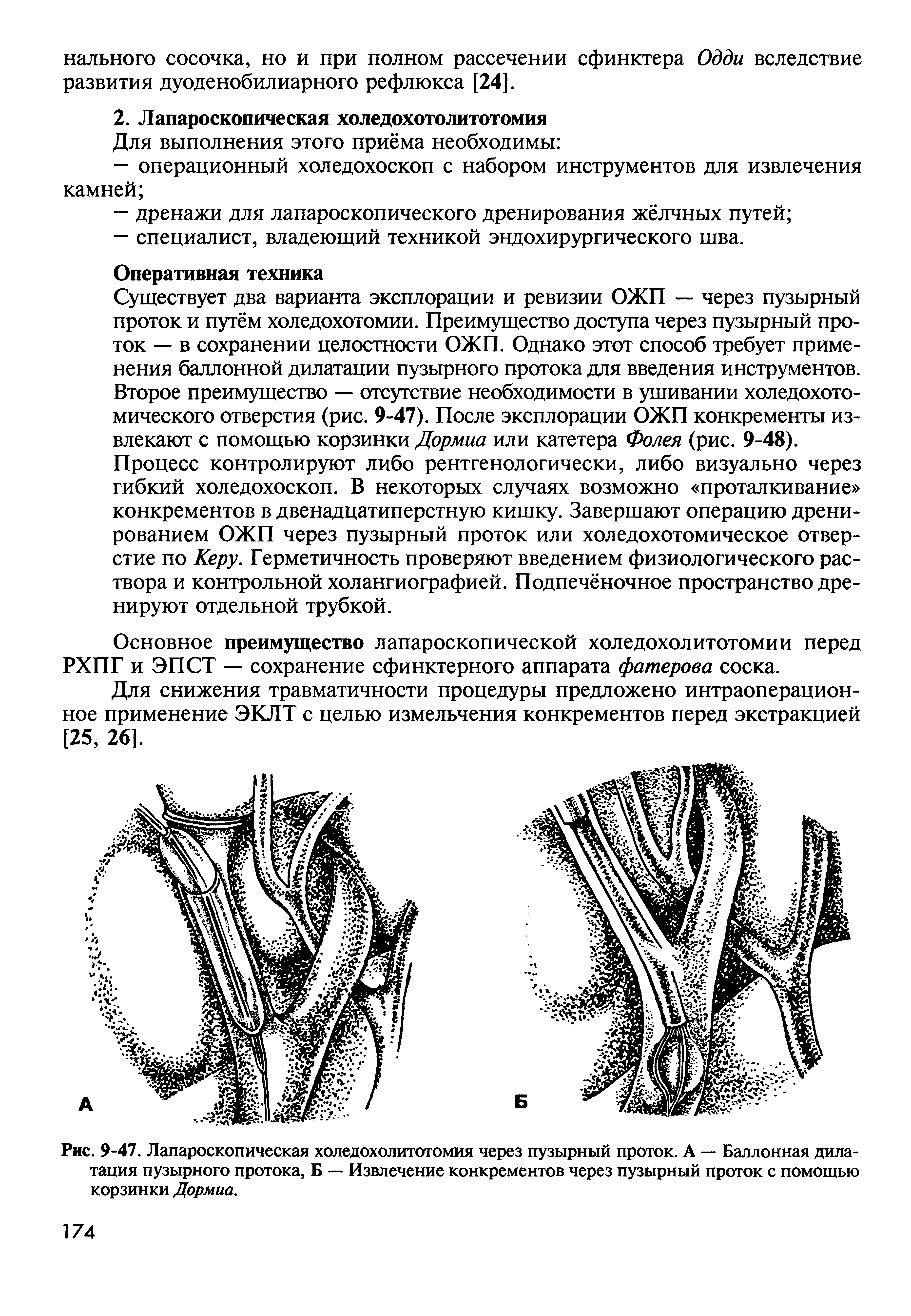 Рис. 9-47. Лапароскопическая холедохолитотомия через пузырный проток. А — Баллонная дилатация пузырного протока, Б — Извлечение конкрементов через пузырный проток с помощью корзинки Дормиа.