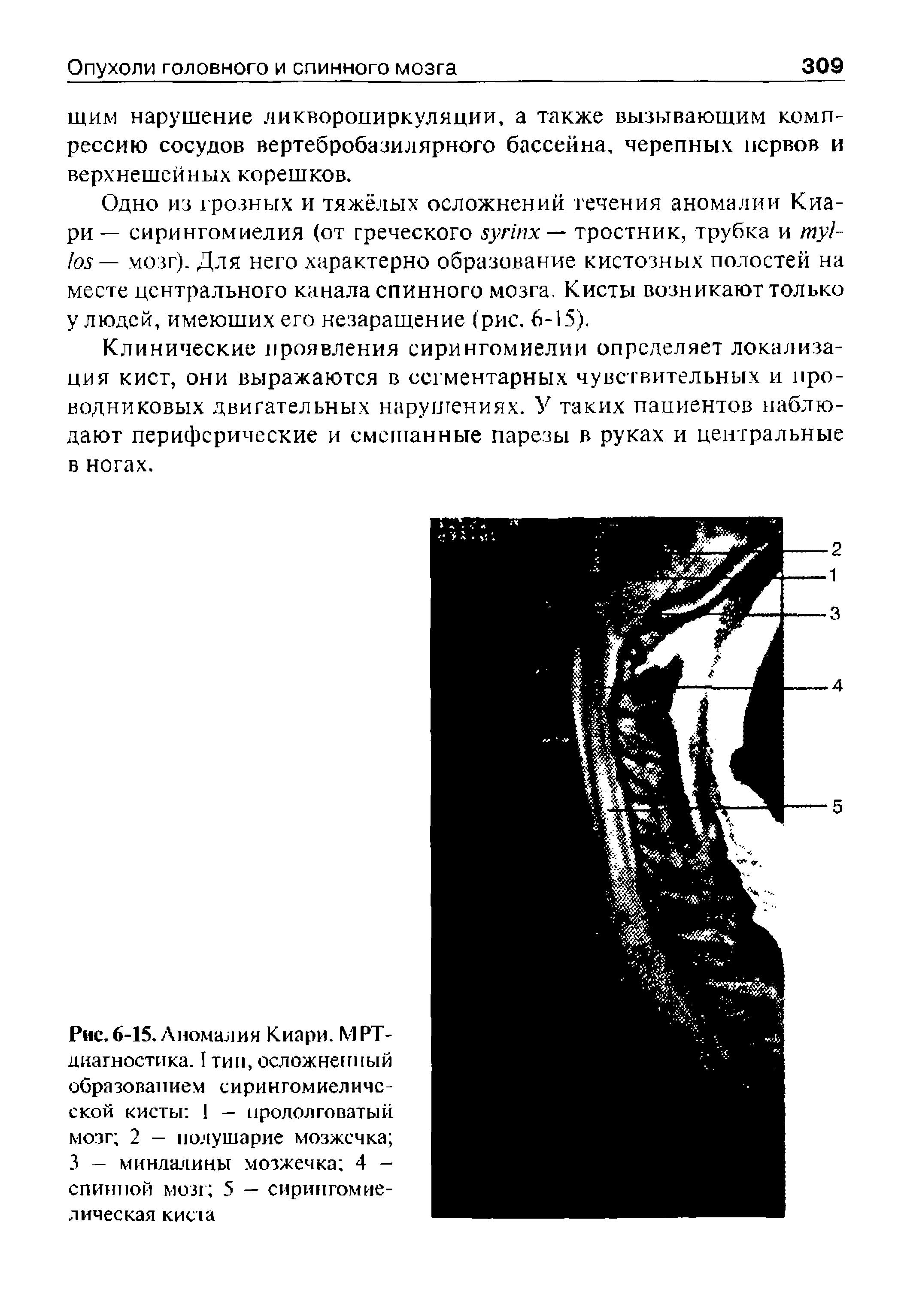 Рис. 6-15. Аномалия Киари. МРТ-диагностика. 1 тип, осложненный образован нем с и ри н гом иел и ч с -ской кисты 1 — продолговатый мозг 2 — полушарие мозжечка 3 - миндалины мозжечка 4 -спинной мол 5 — сирипгомие-лическая кисла...